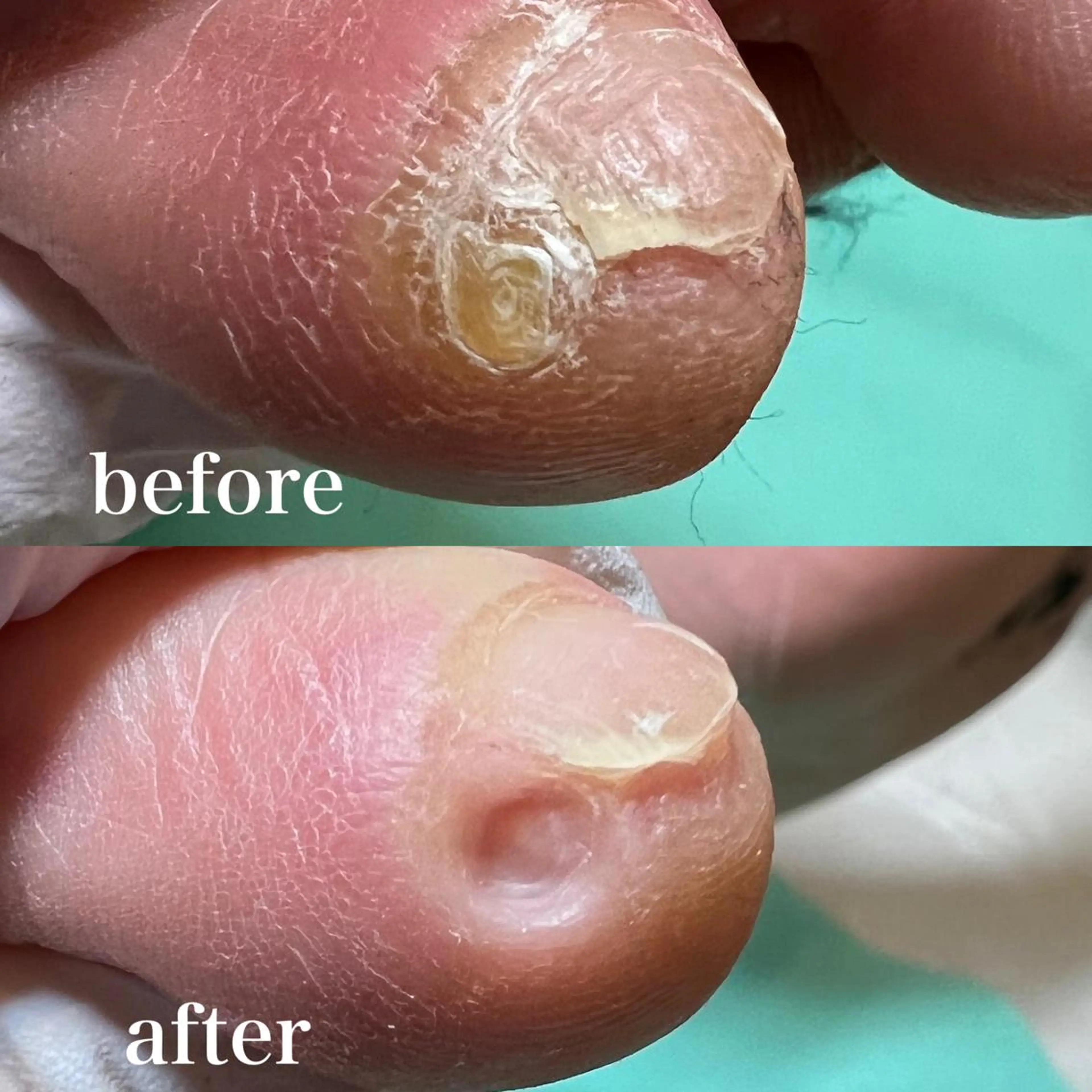 ネイル 東京巻き爪 アカデミーのエステ・リラクイメージ