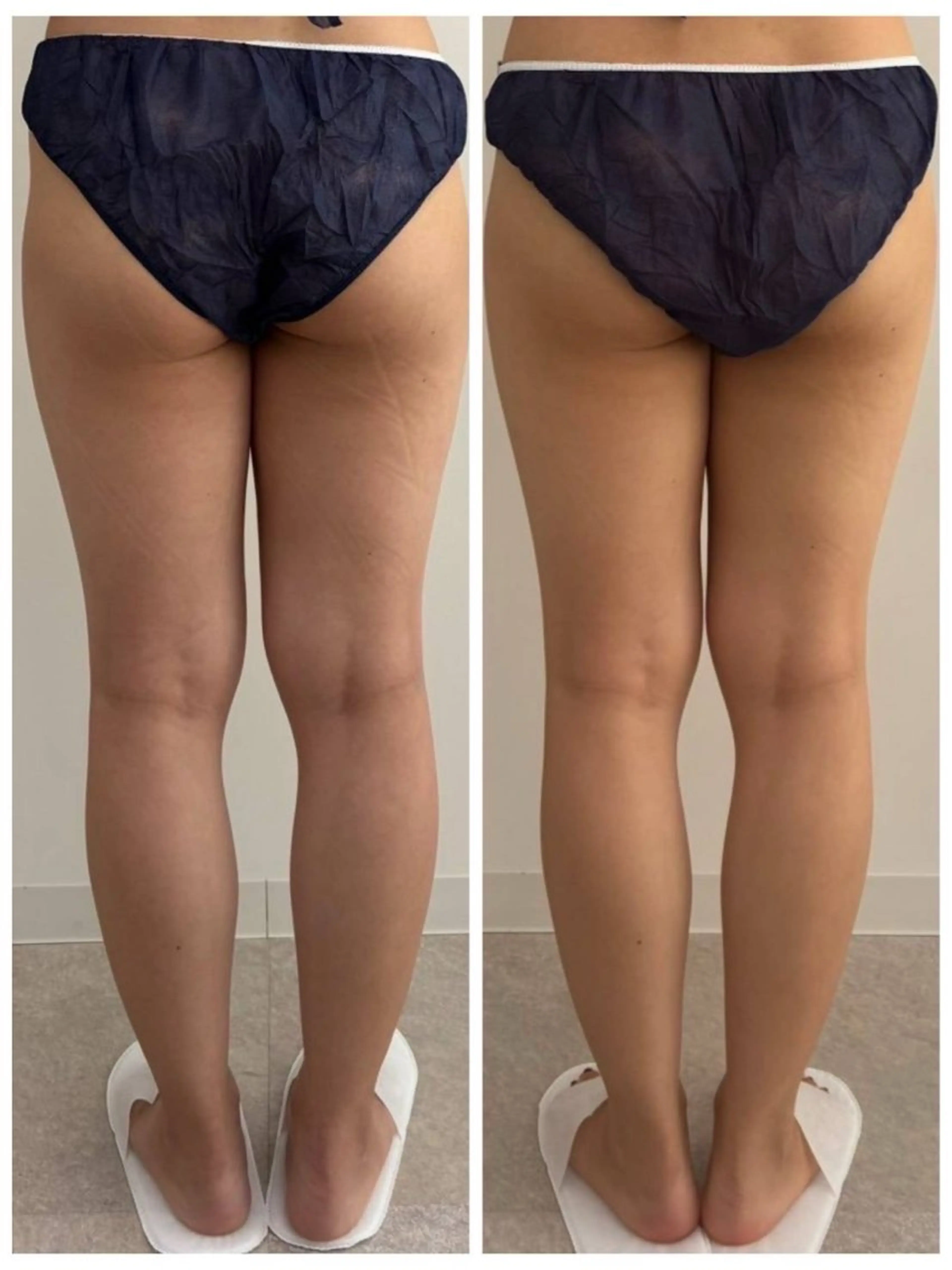 【伏見/脚痩せモニター】SNS・HP掲載協力で17,600円相当➔8,000円！選べる温熱or引締めケア✨月2枠限定の写真