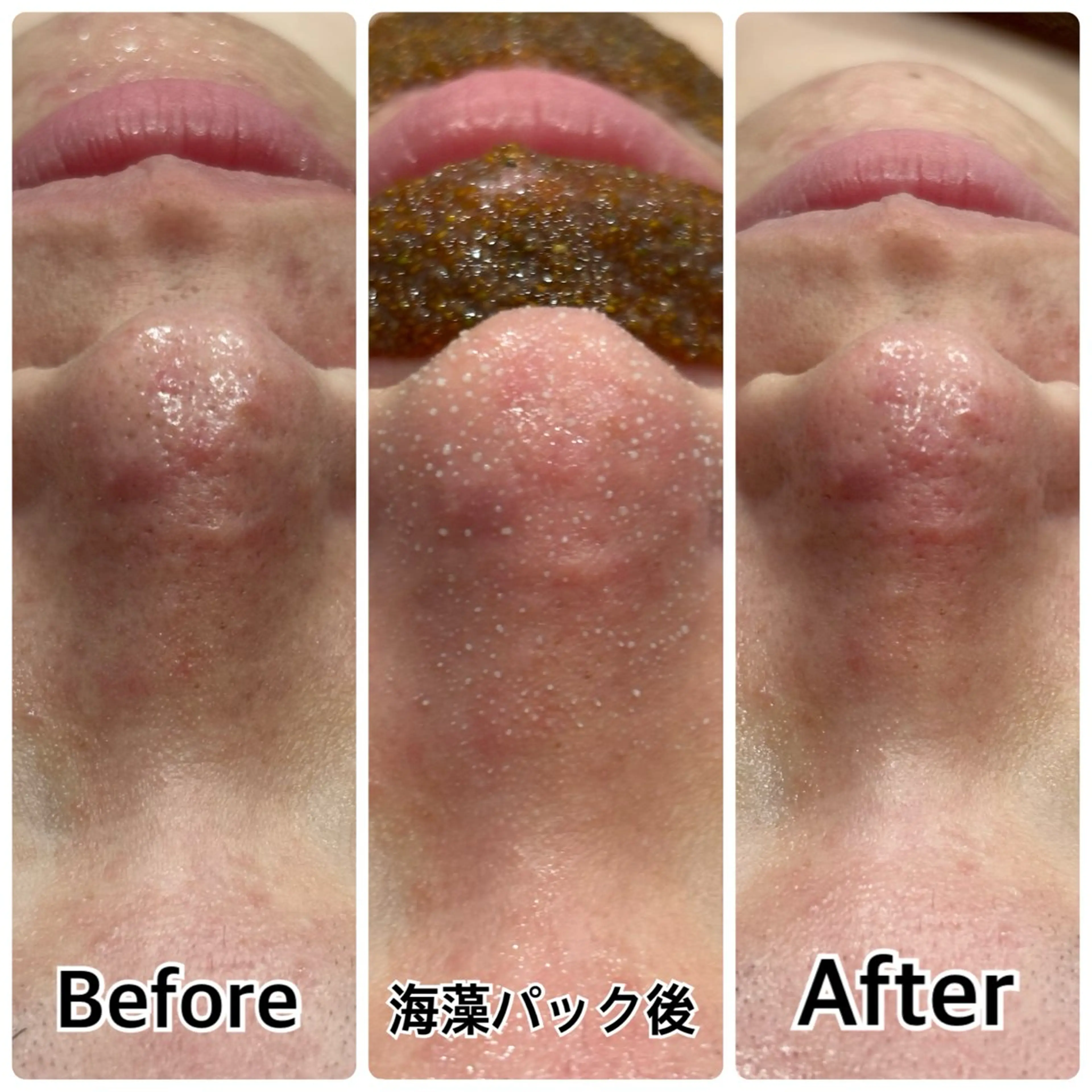 【新規女性/平日限定/この春褒められる肌作り】毛穴洗浄＋顔無VIO込全身脱毛の写真