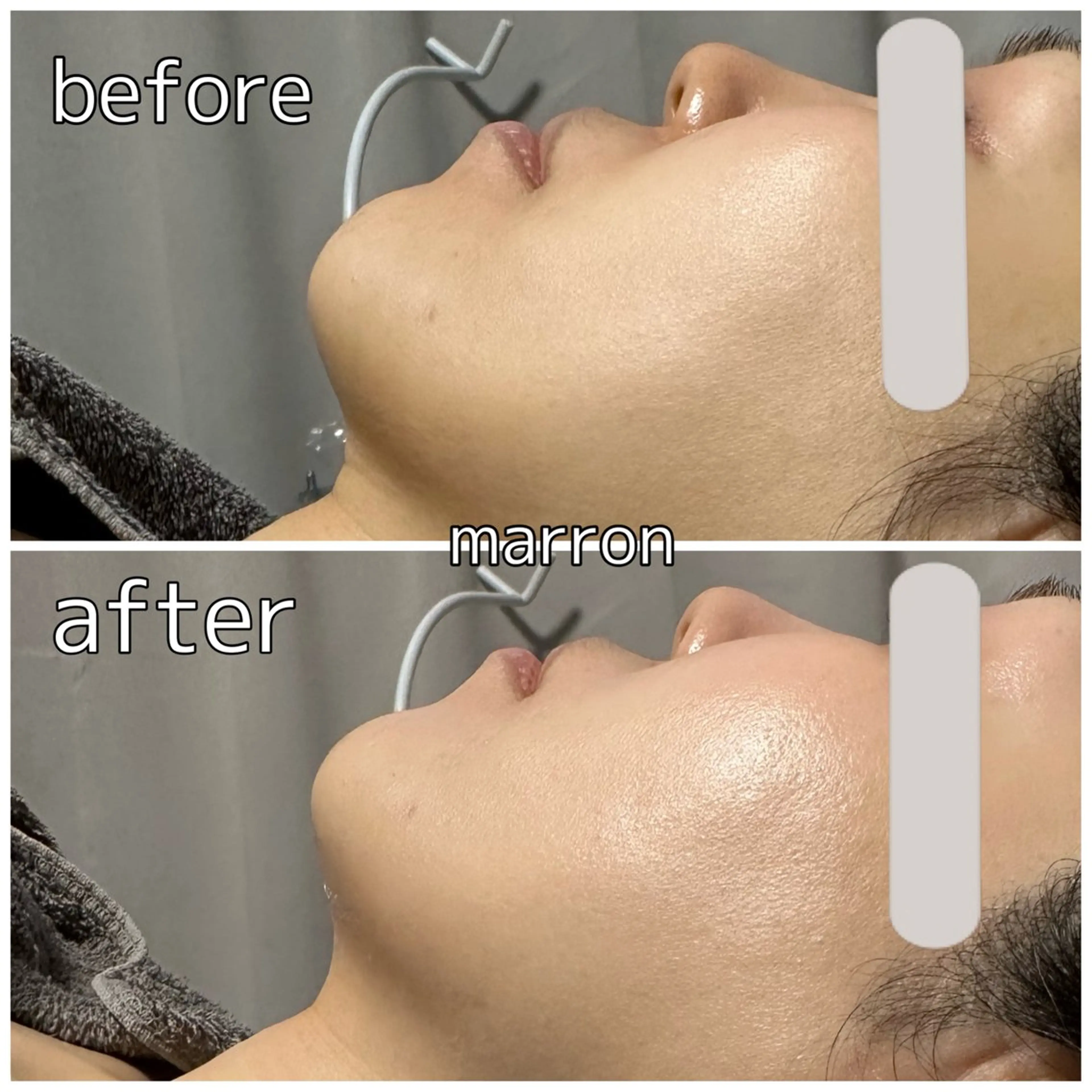 痩身ハイパーナイフ ララピールリアボーテのエステ・リラクイメージ