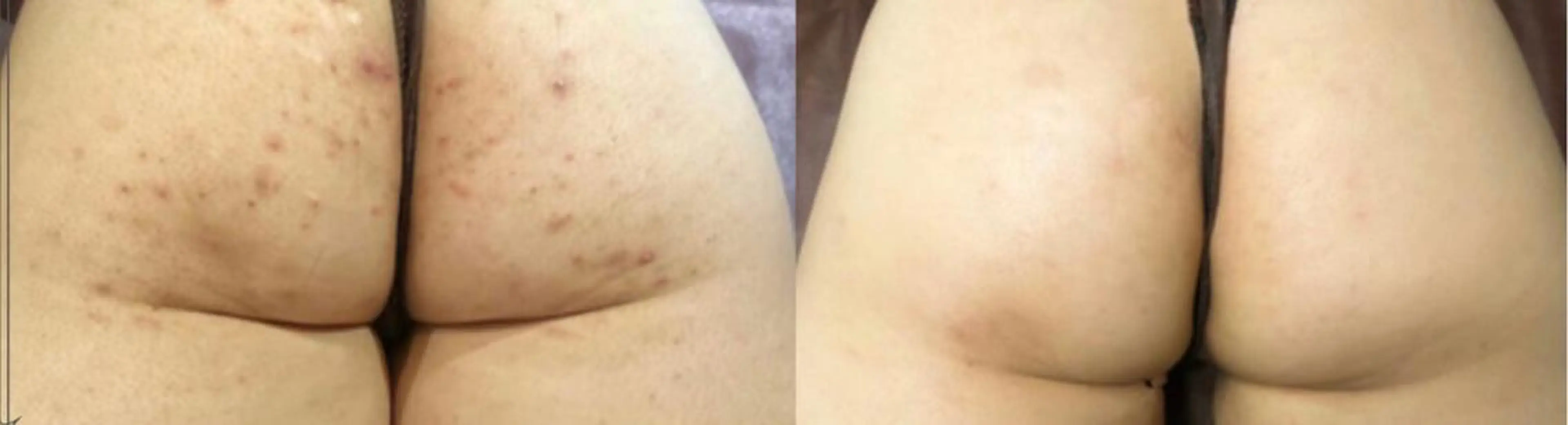 ハーブピーリング(ボディ)の写真