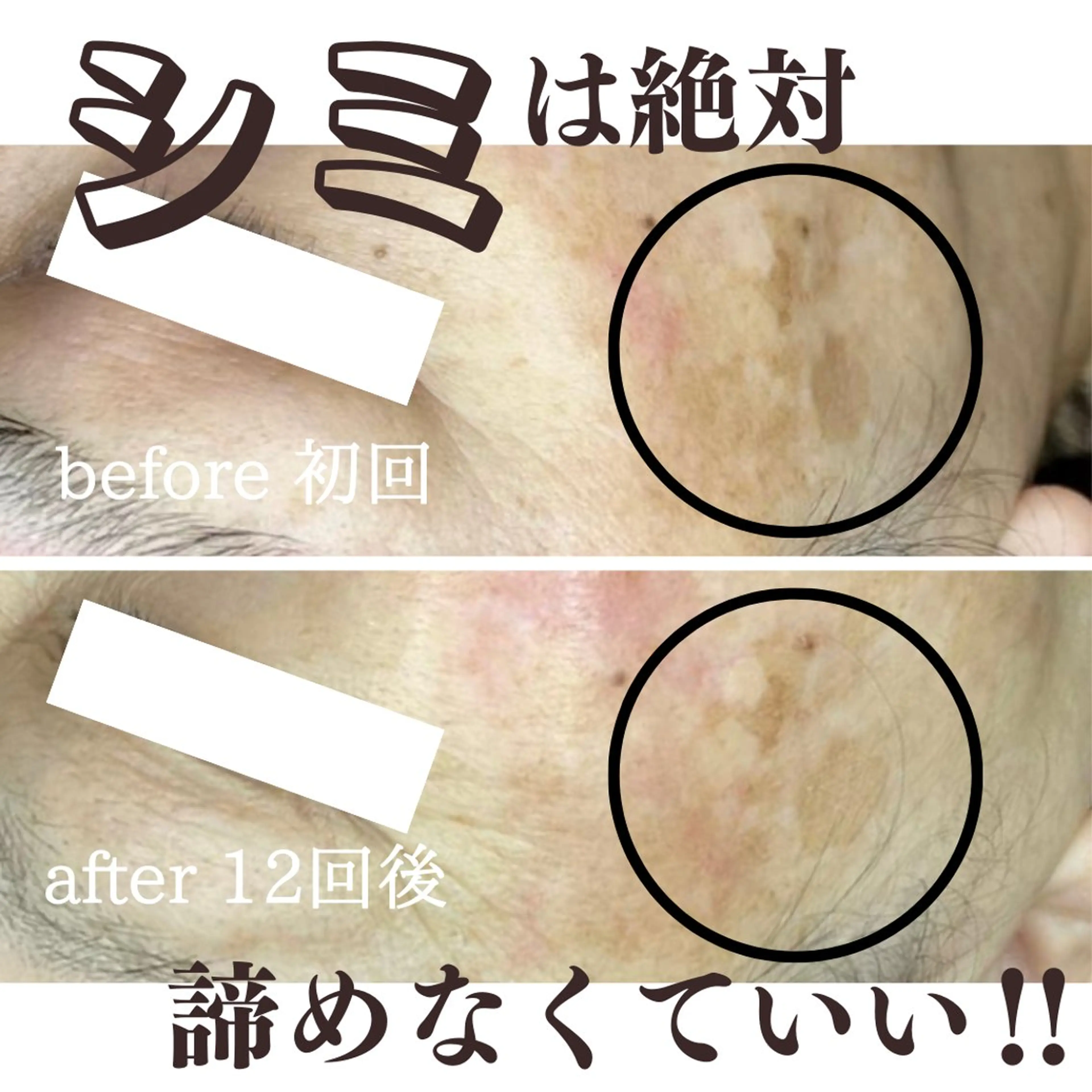 【最新の次世代シミケア】20ショットの写真