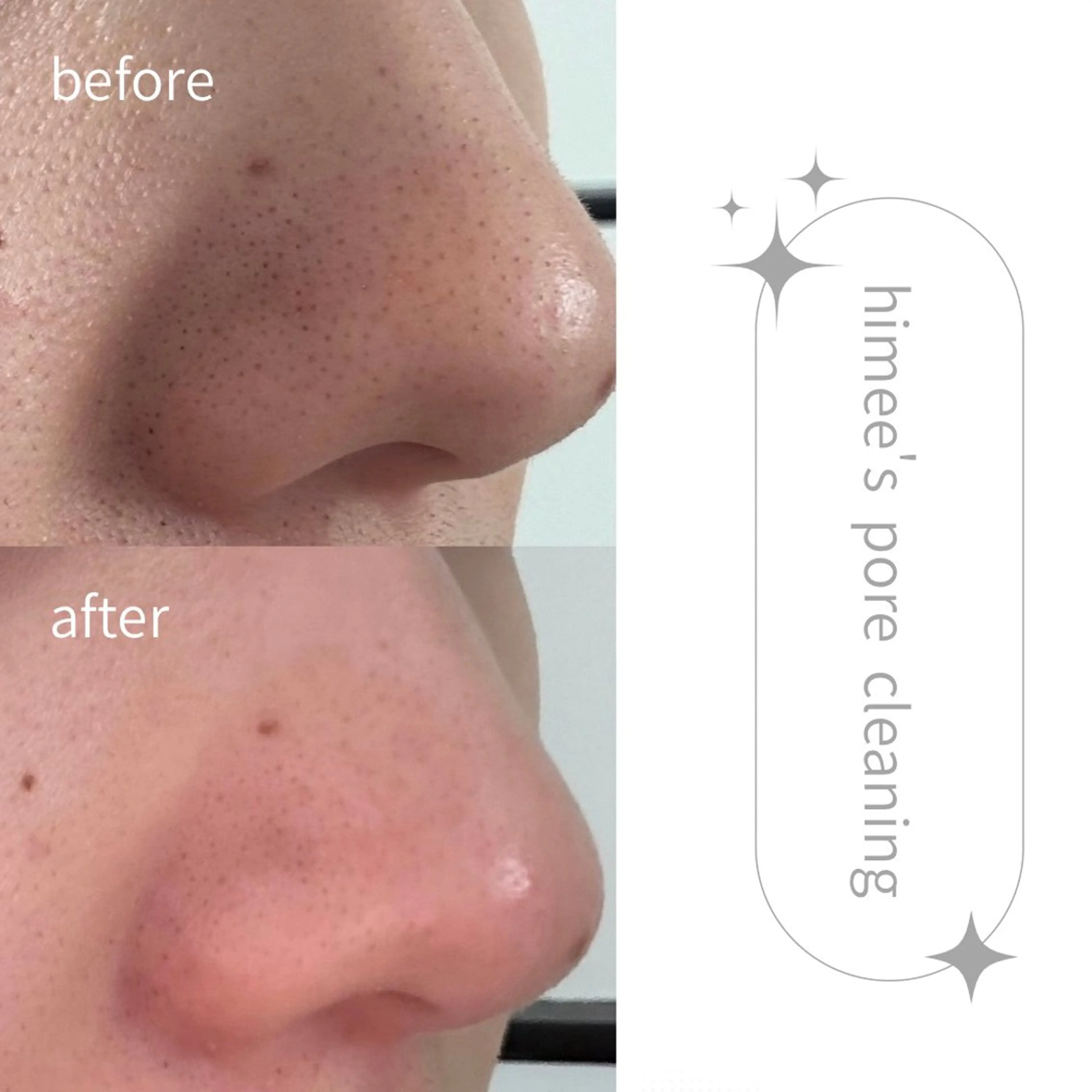 エステ リラク 艶肌ハーブピーリング /毛穴洗浄のエステ・リラクイメージ