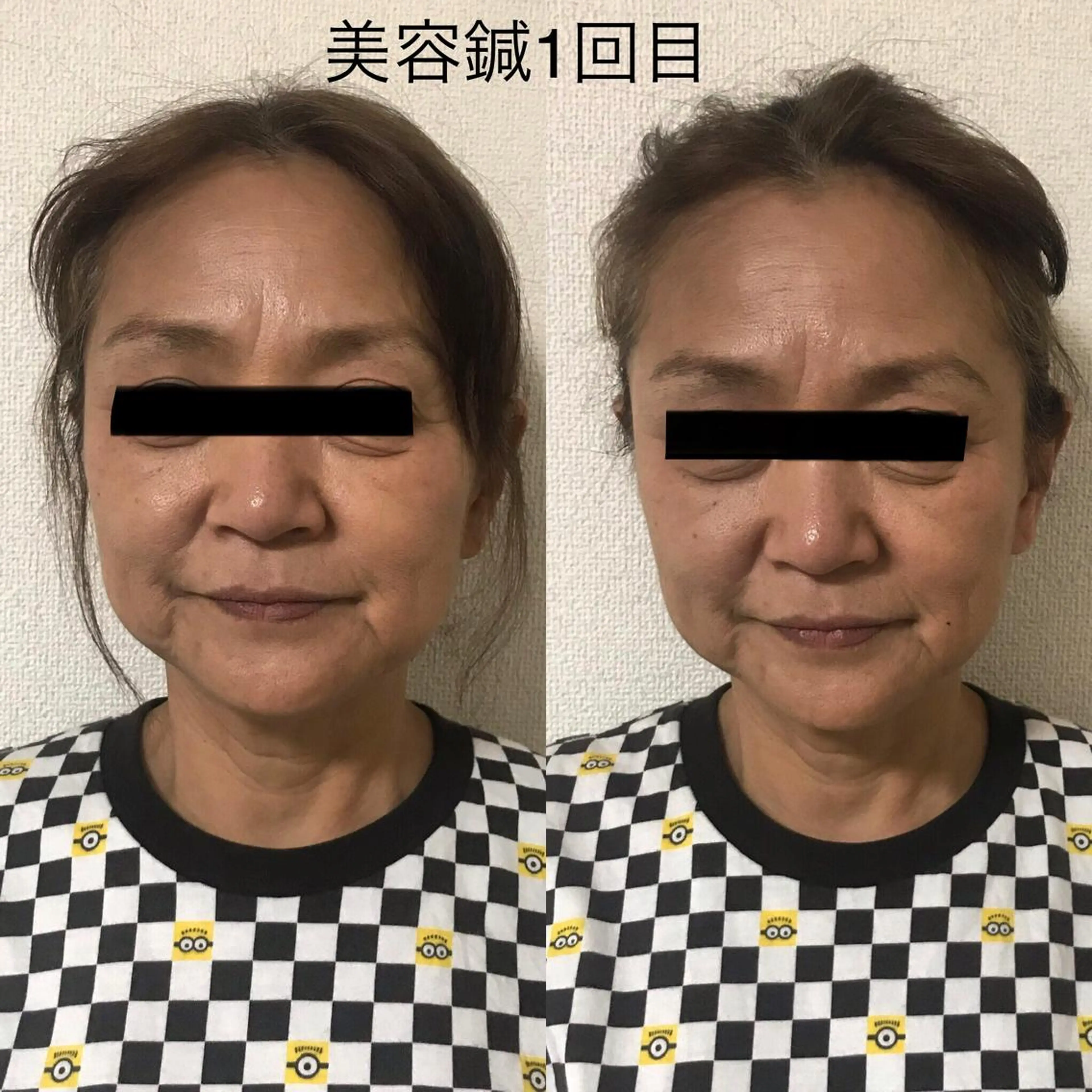 その他 マッツンの 鍼のその他イメージ