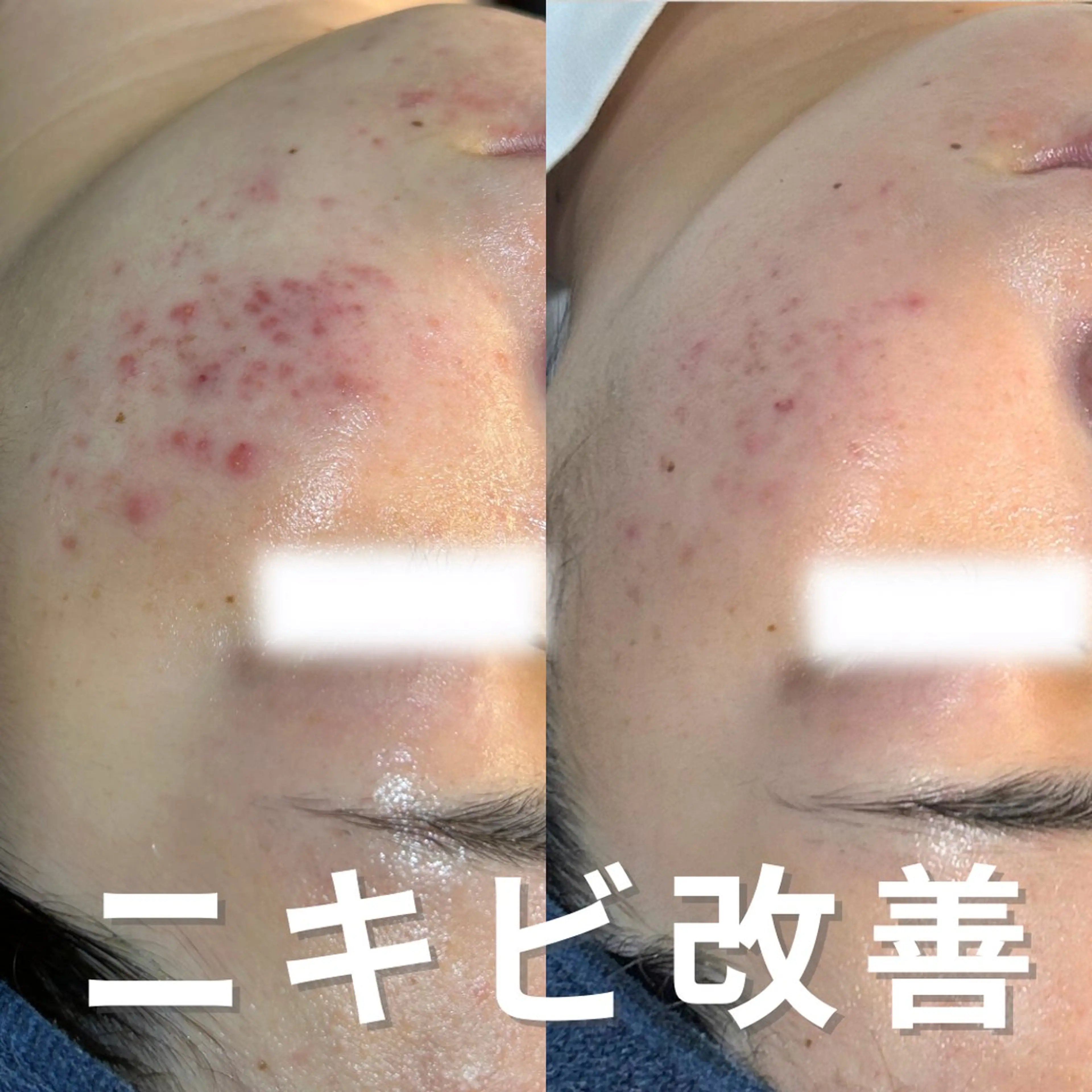 エステ ニキビ・ニキビ跡改善 leoloのエステ・リラクイメージ