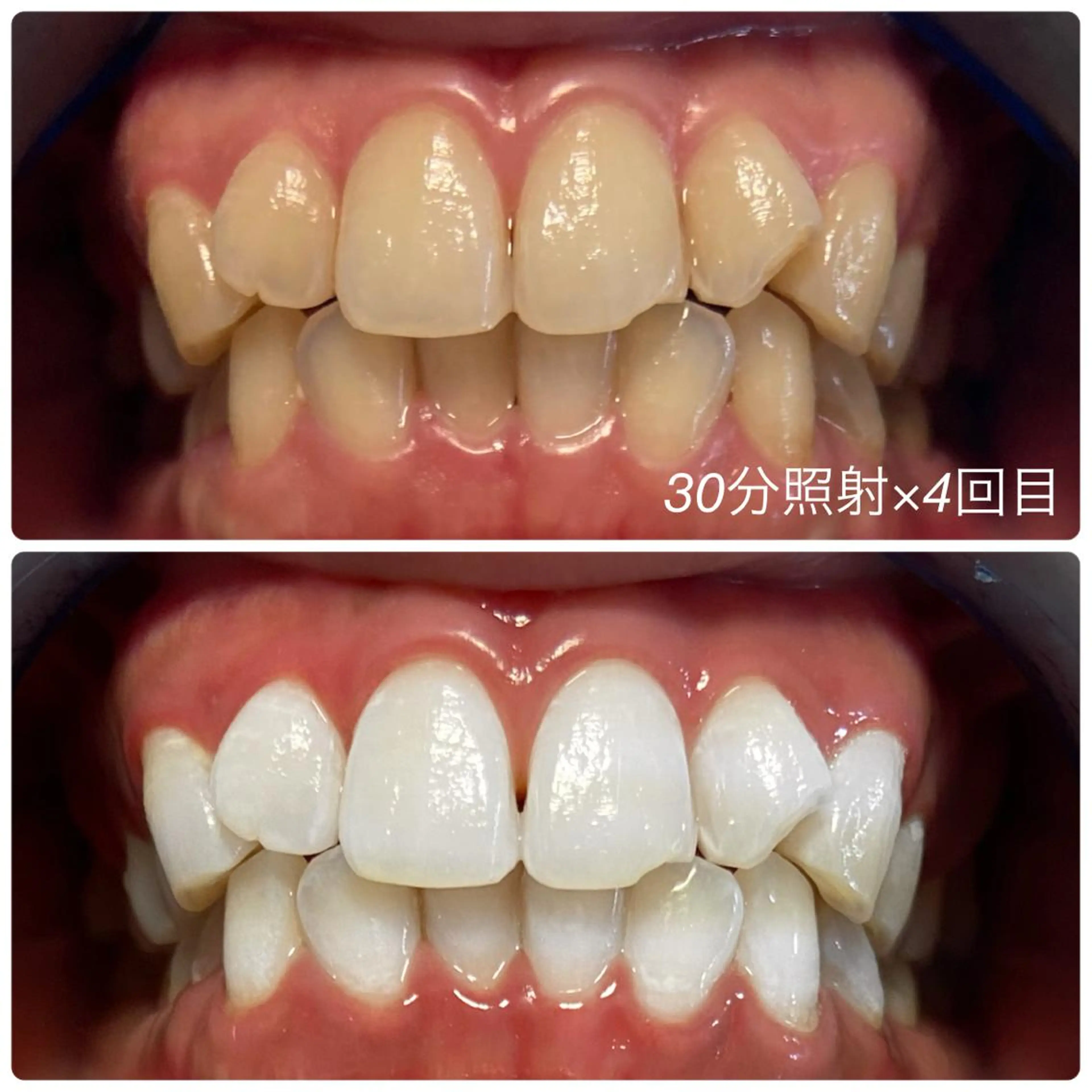 【特別お試しプラン】セルフホワイトニング 30分照射 × 3回チケットの写真