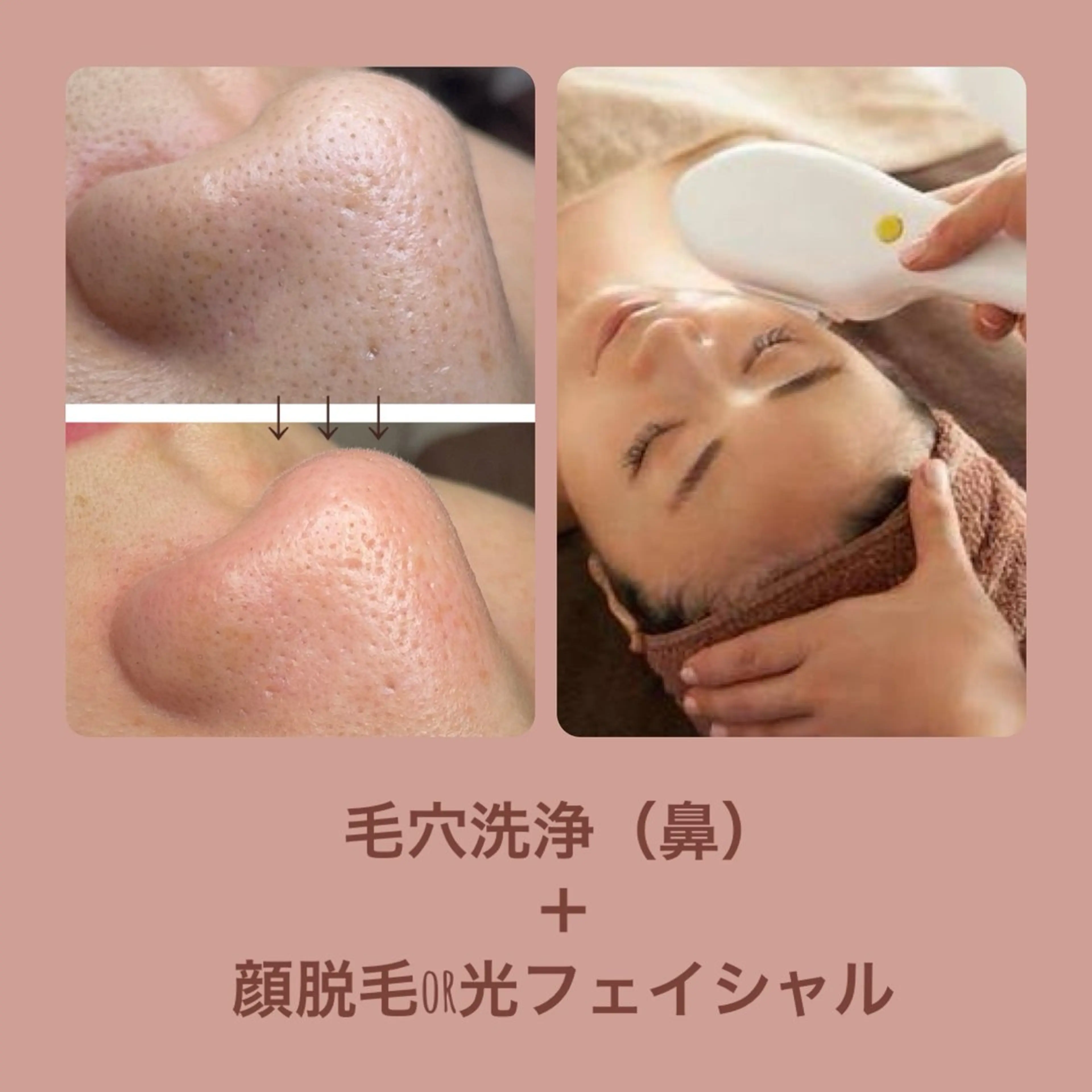 【完全都度払い】毛穴洗浄(鼻)+顔脱毛or光フォトの写真
