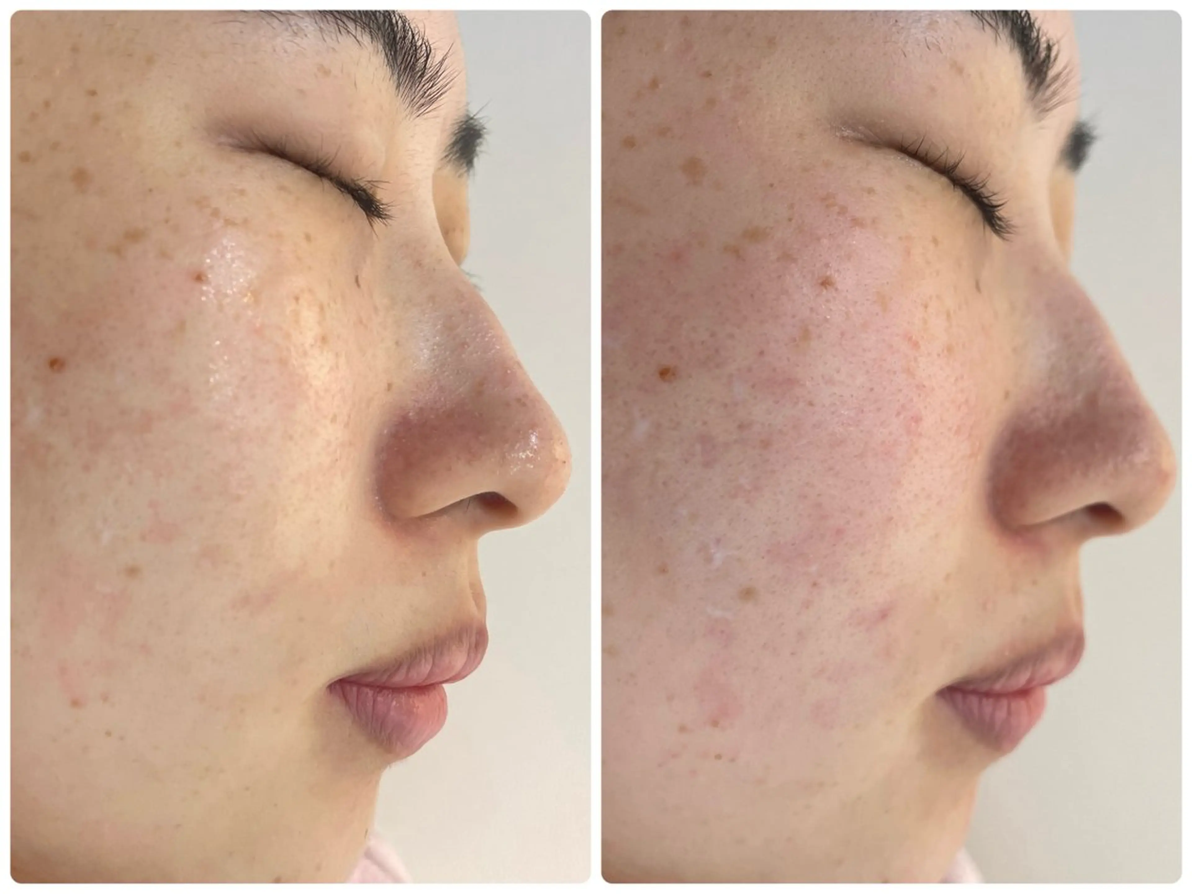 【赤み・乾燥が気になる方へ】ゆらぎ肌をやさしく整える保湿ケアの写真