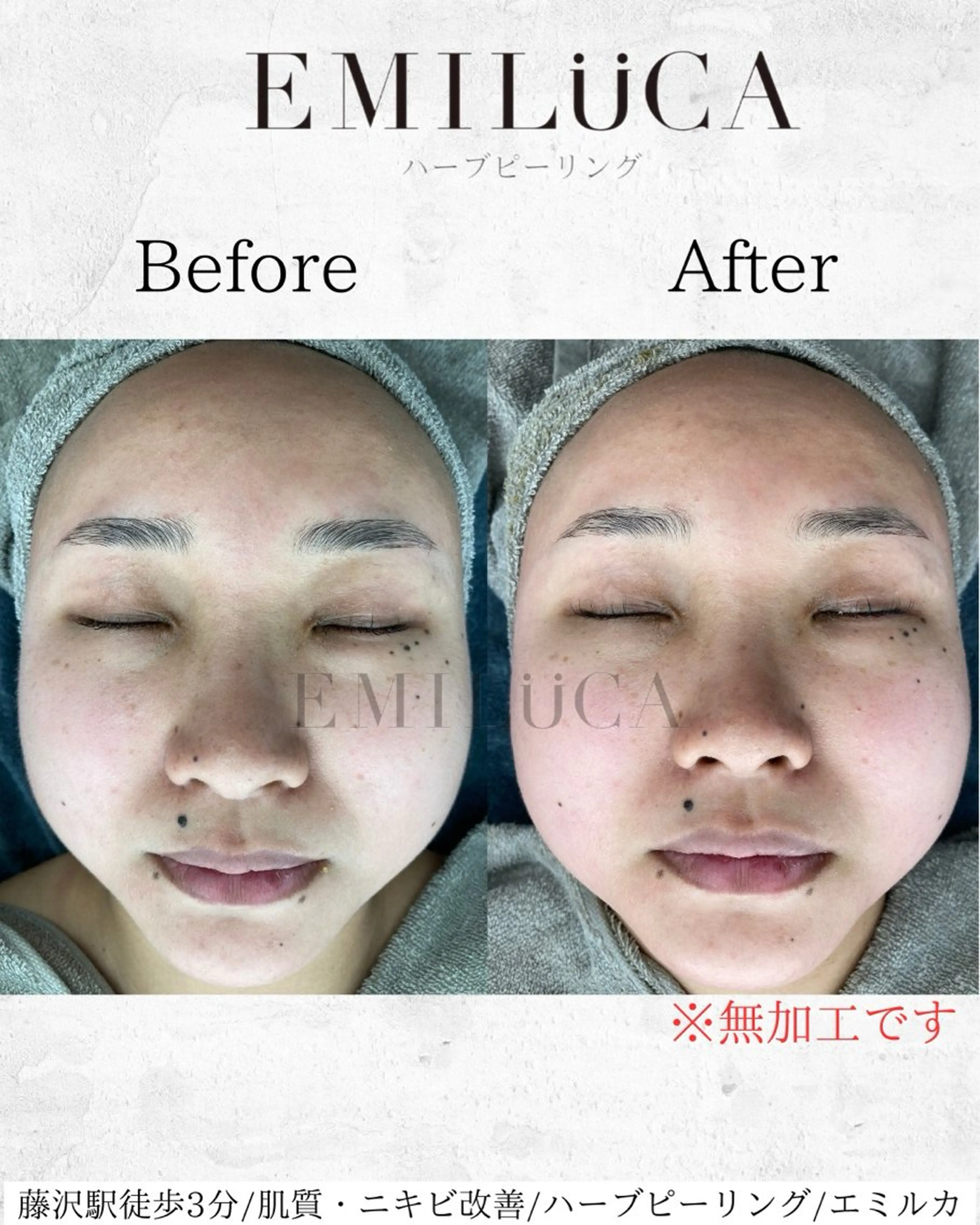 エステ ハーブピーリング /KAEDEのエステ・リラクイメージ