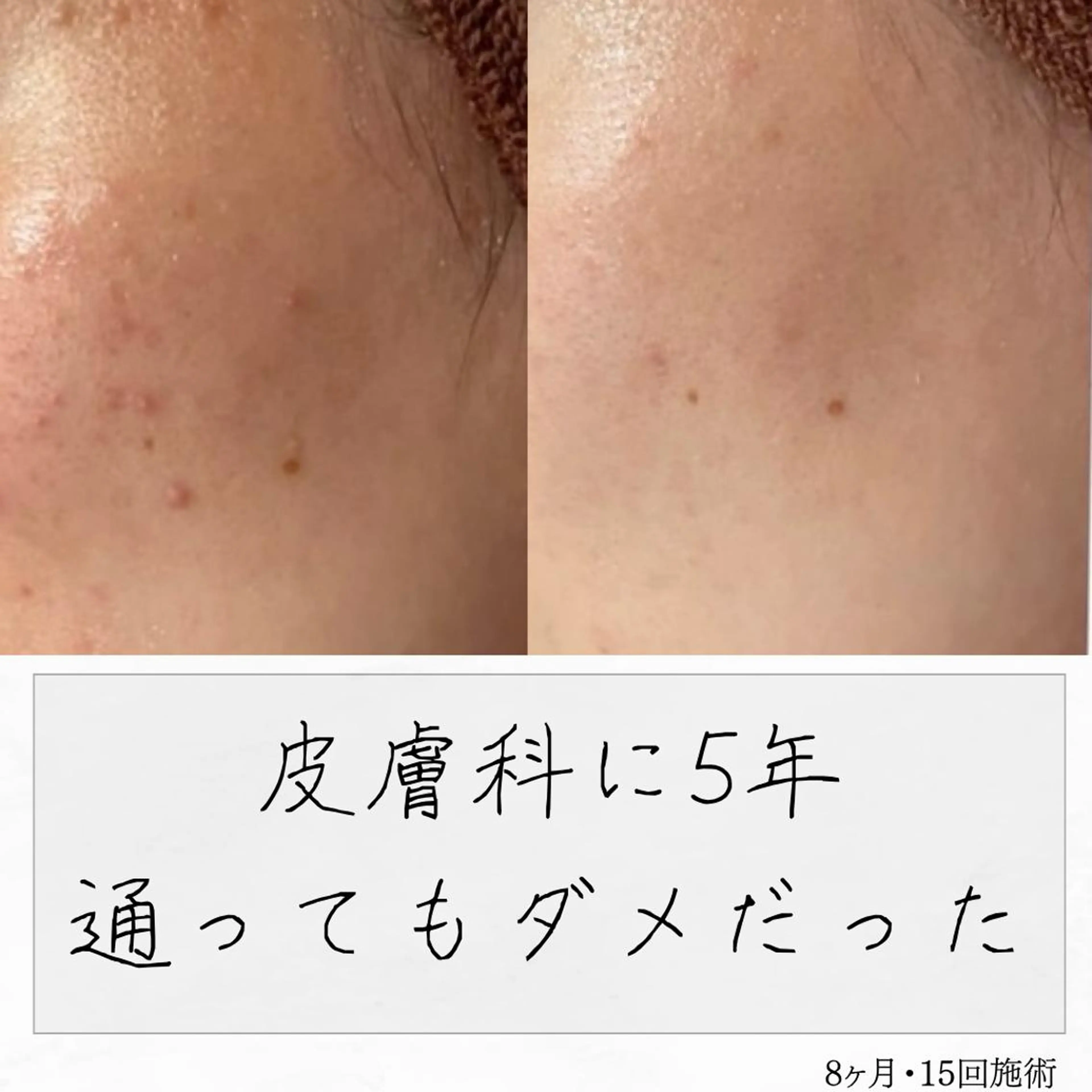 ニキビ経験者が施術 する専門サロン🌻のエステ・リラクイメージ