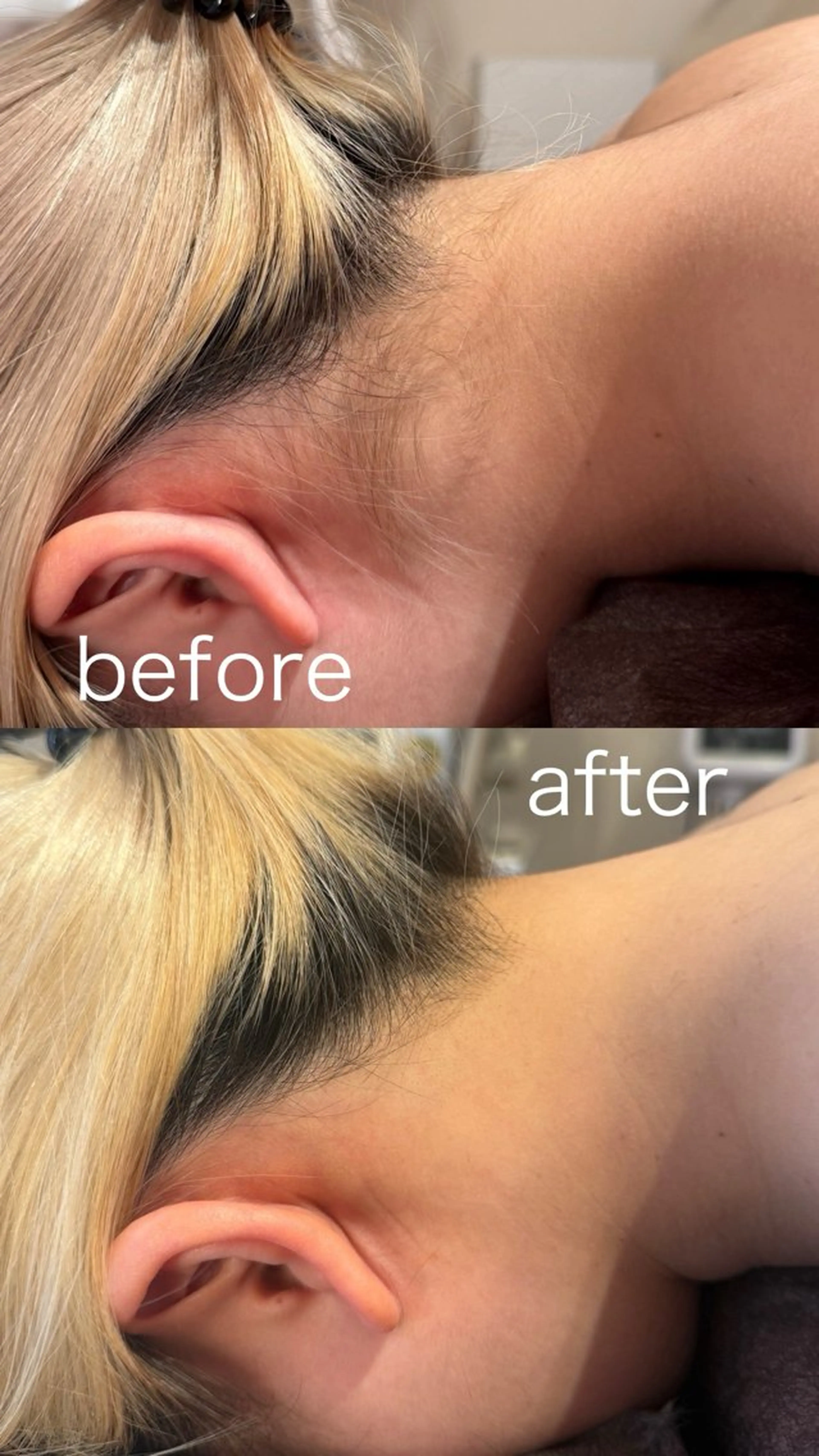 ミニモ学割👩🏼‍🎓全身脱毛(顔、VIO込み) | 40%OFF❣️16,500→＼9,900円／の写真