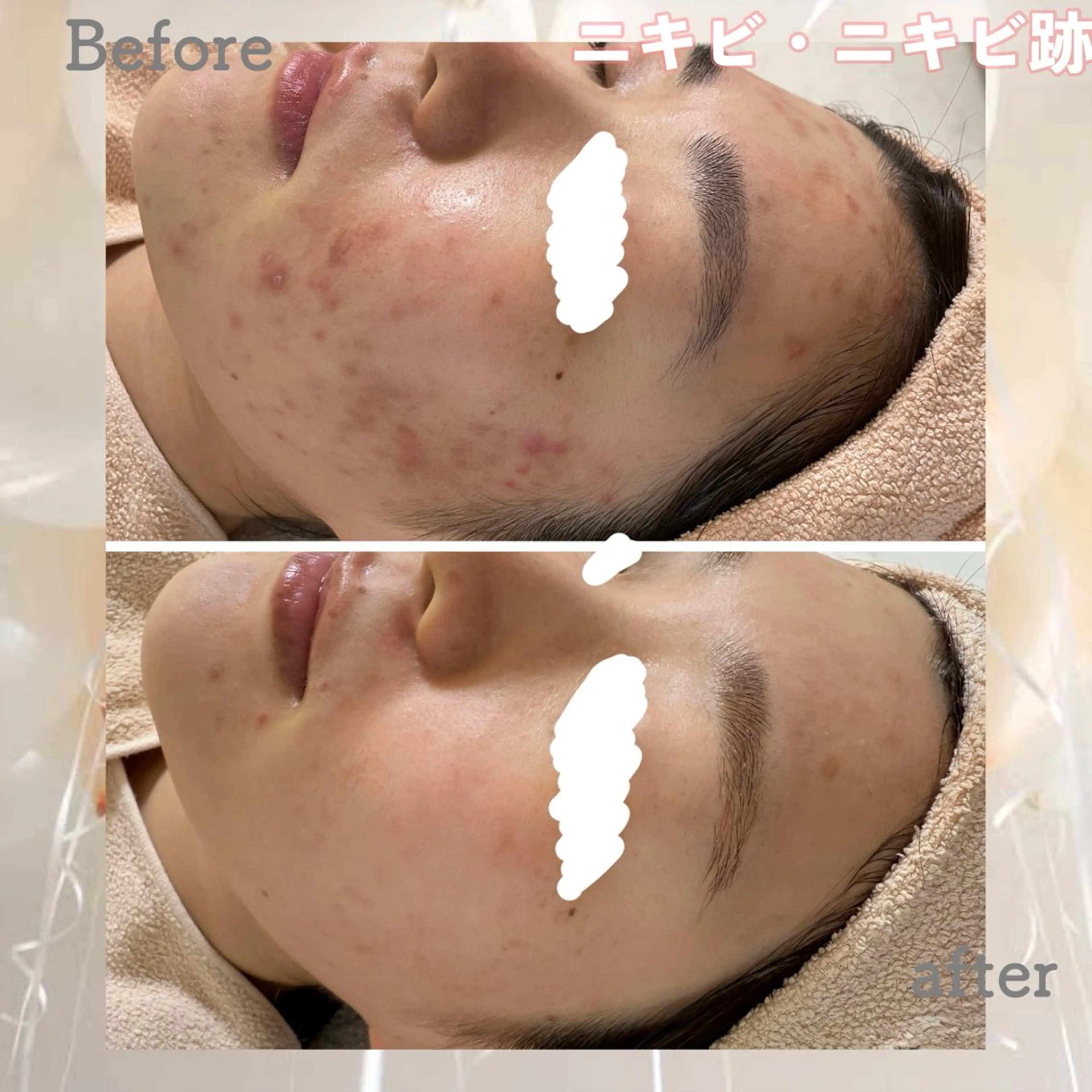 エステ ニキビ&跡改善サロン オーナー光木のエステ・リラクイメージ