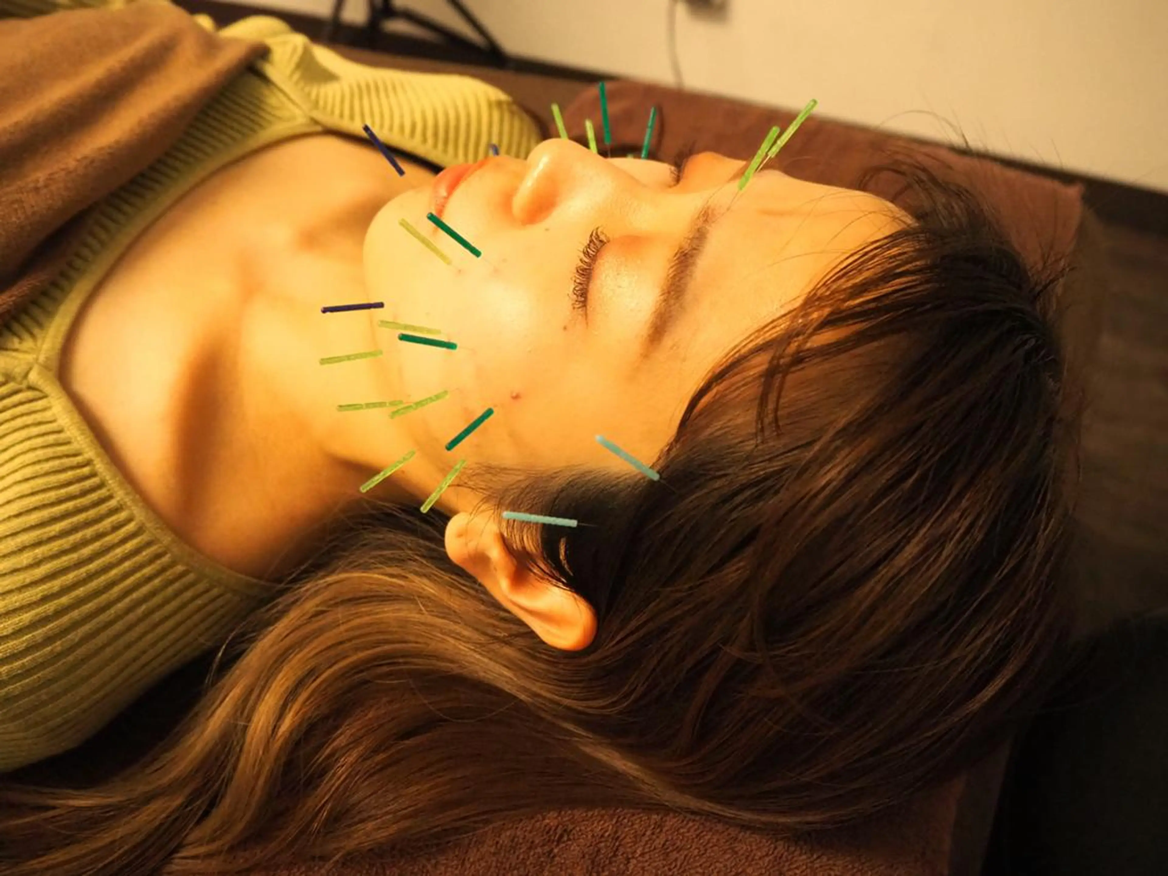【肌荒れ改善メニュー】美容鍼+本数アップ(15本)+首肩背中マッサージの写真
