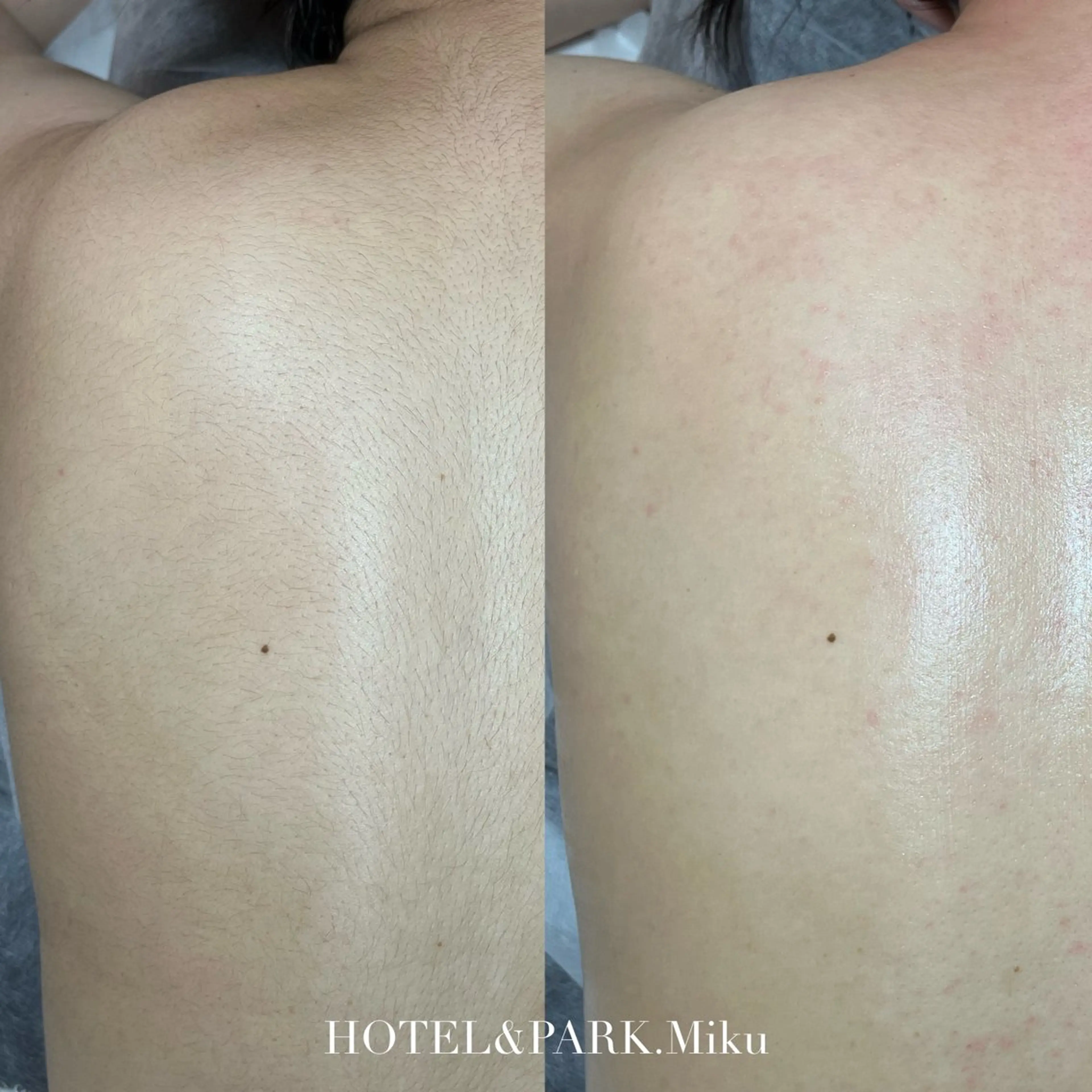 脱毛 HOTEL&PARK Mikuワックス脱毛のエステ・リラクイメージ
