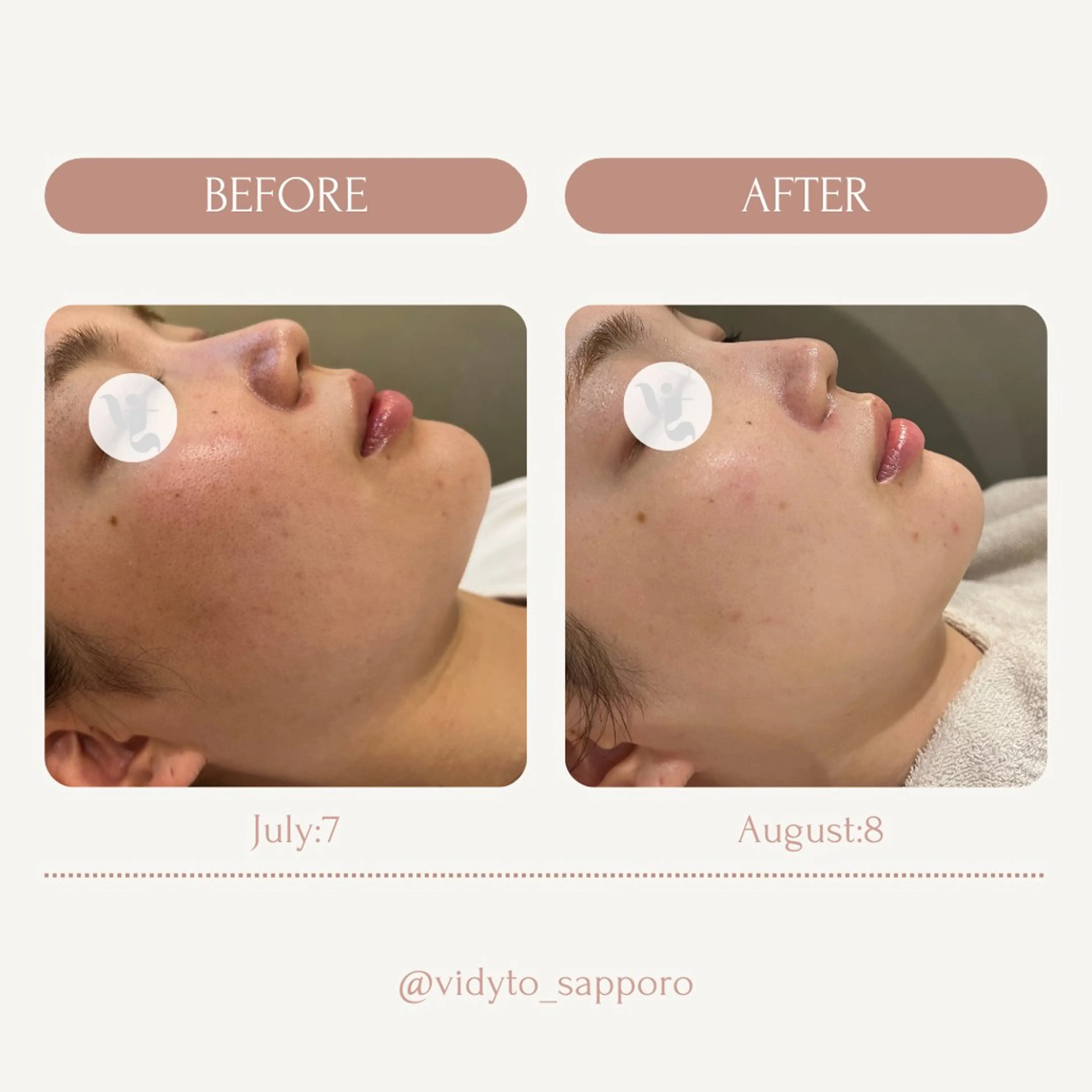 【vidyto】ヴィディトゥ所属・肌管理サロン vidyto　MOEのエステ・リラクイメージ