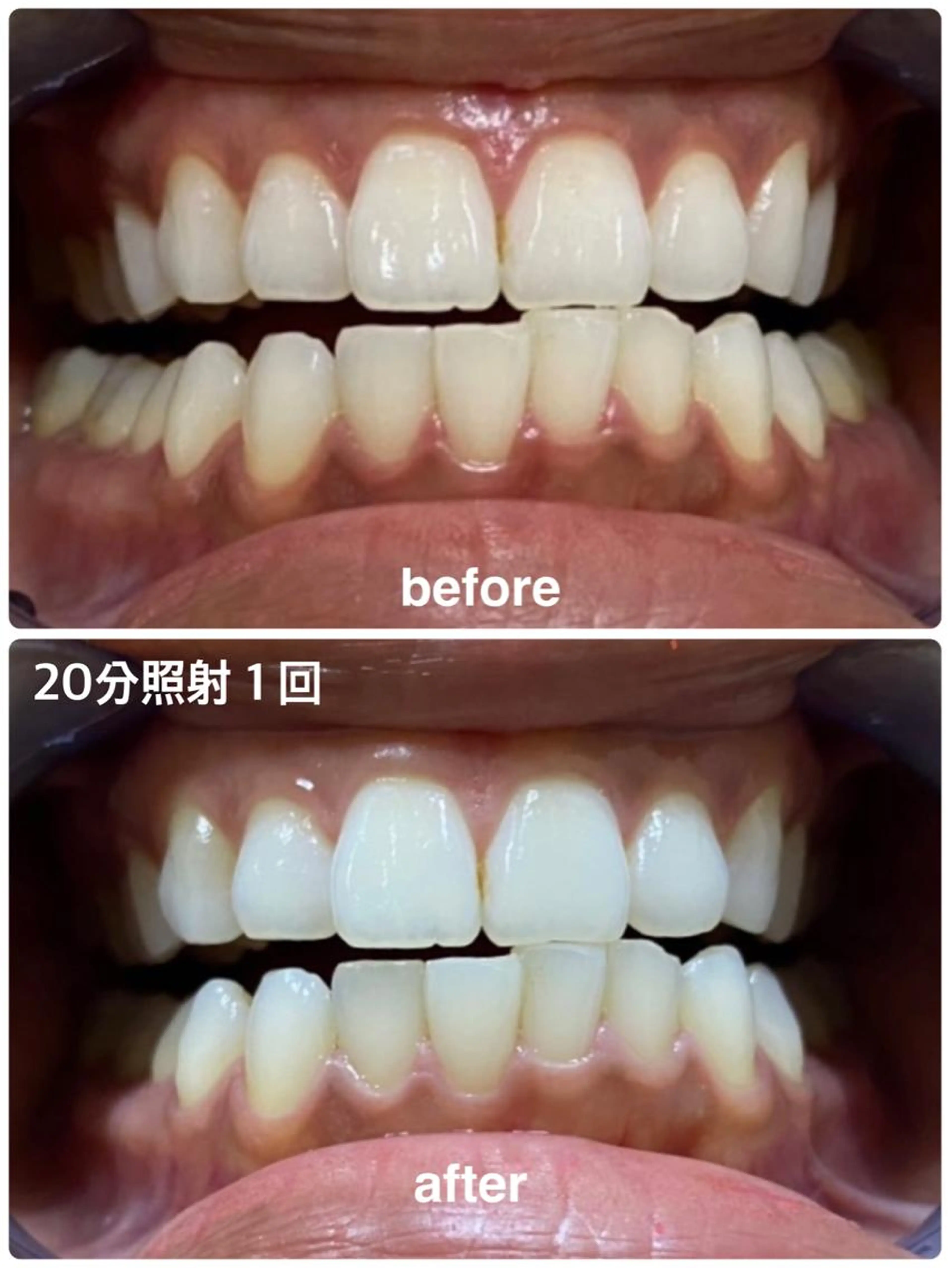 【歯の黄ばみ】白くするホワイトニング40分コースの写真