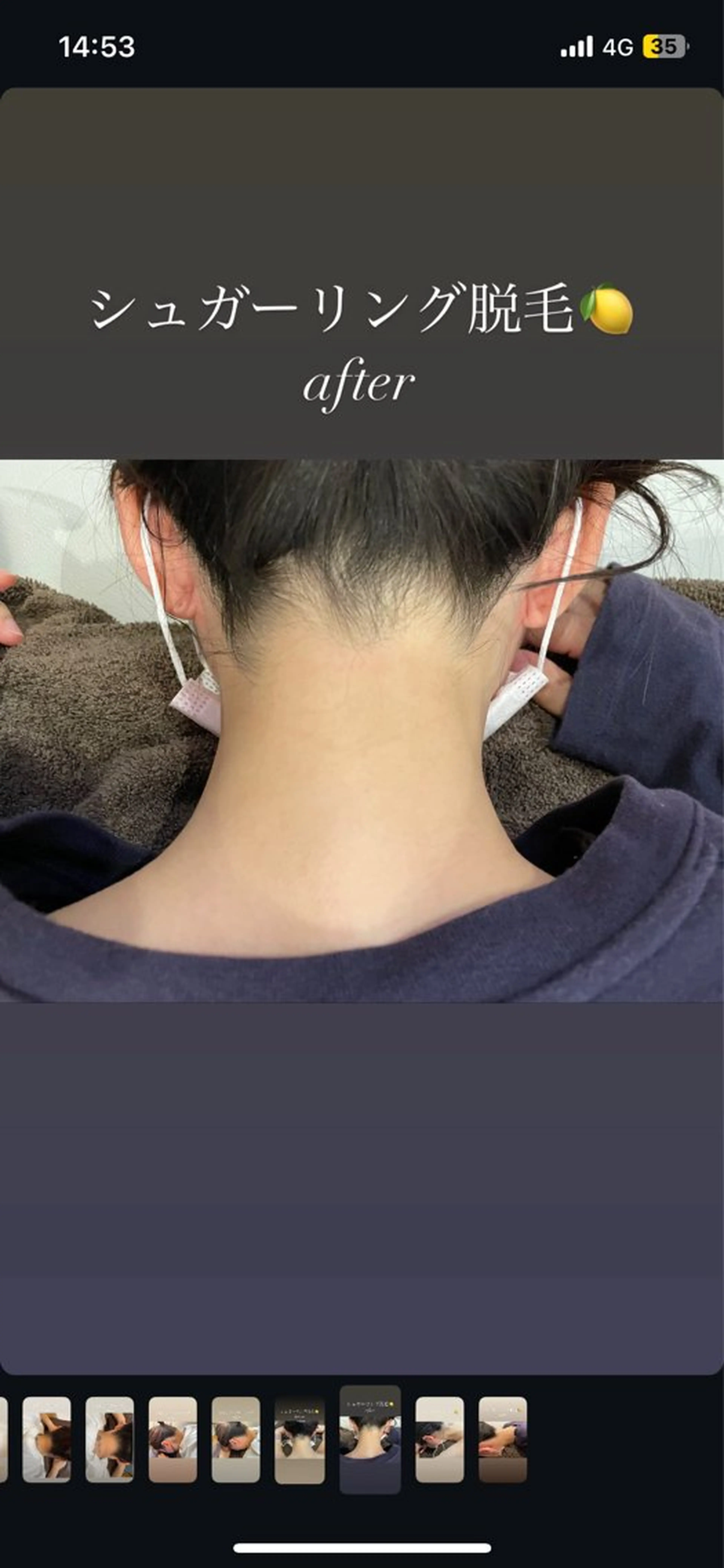 うなじ脱毛✨の写真