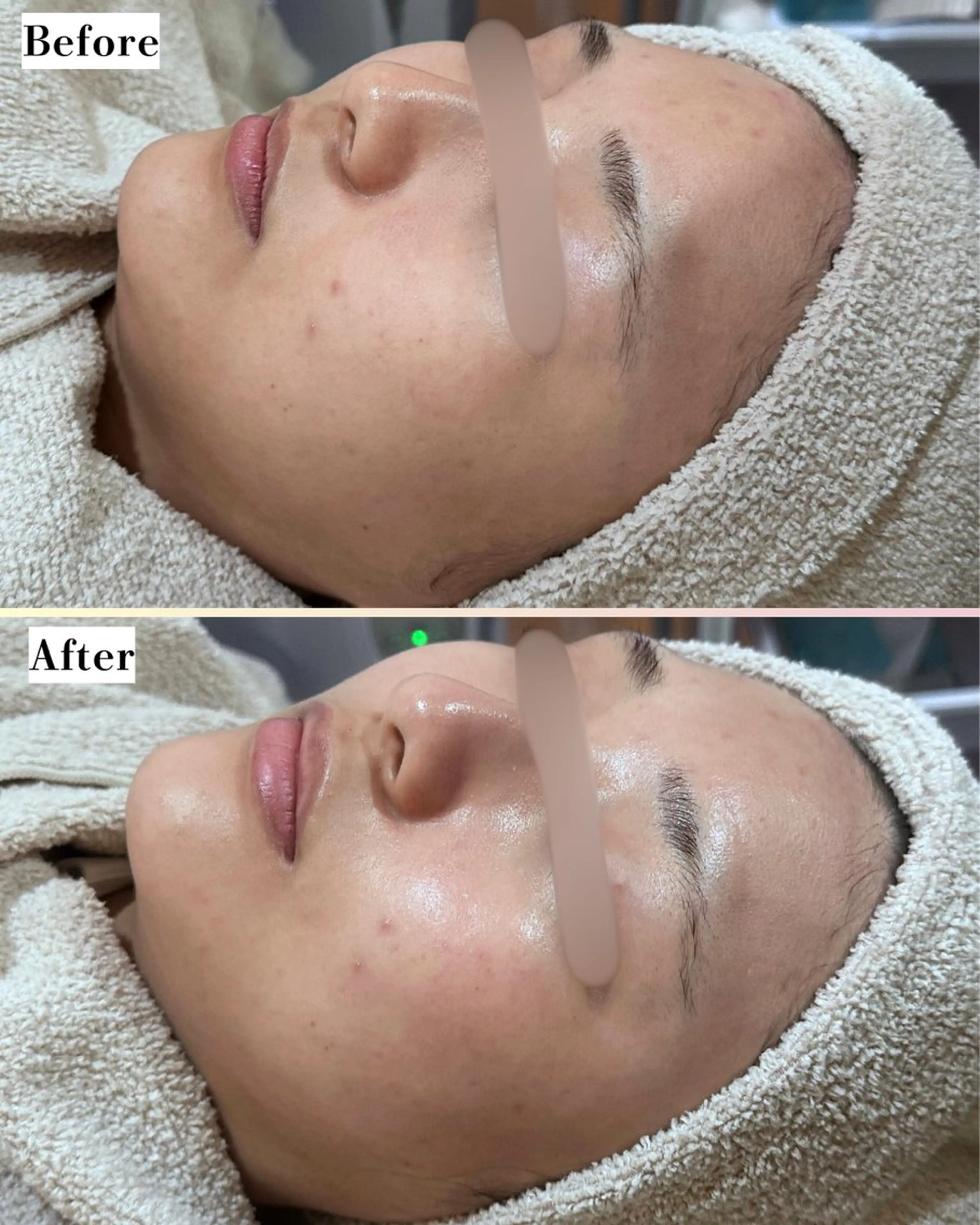 エステ |ピーリング・毛穴| soina神楽坂のエステ・リラクイメージ