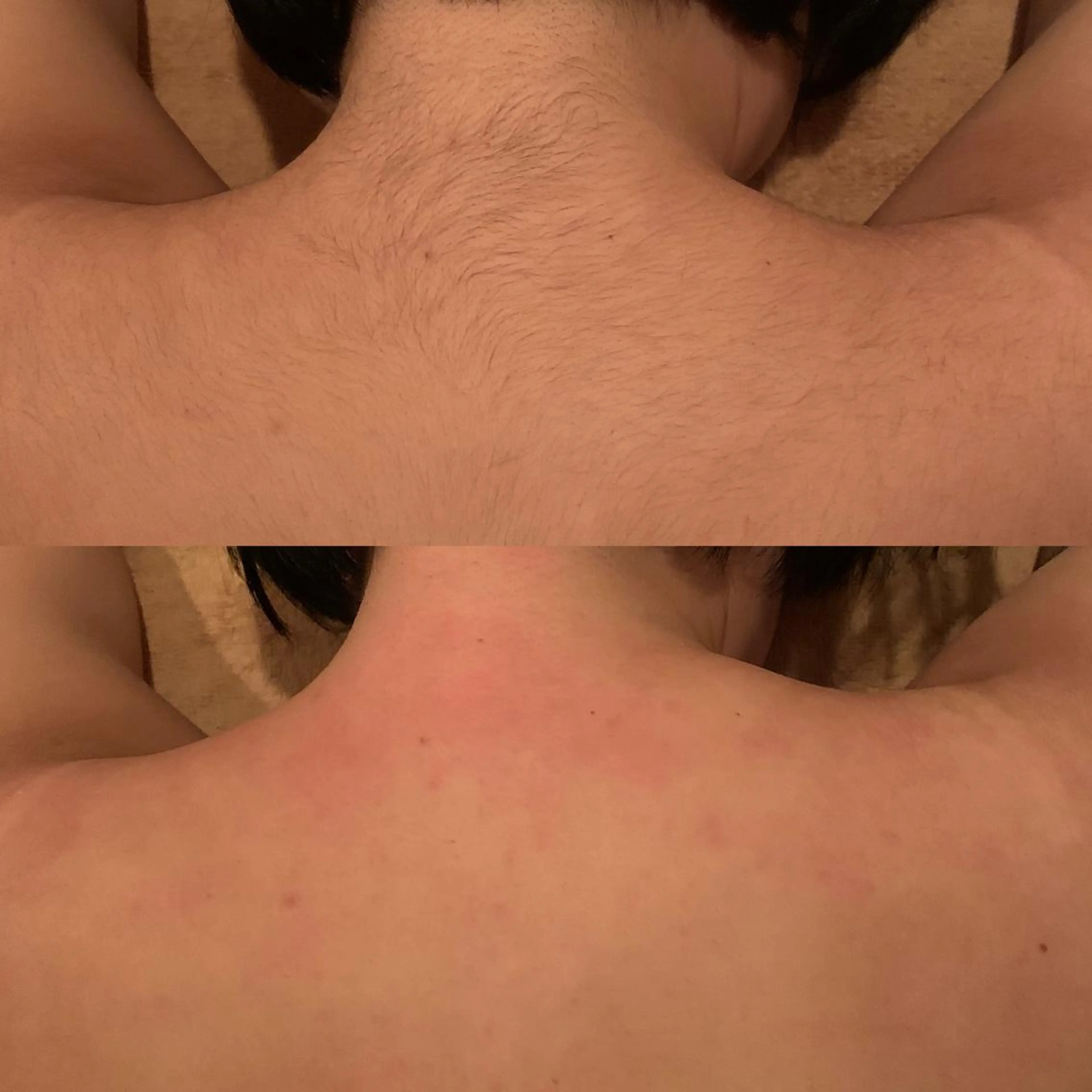 【背中美人】背中ワックス脱毛　(背中上) or (背中下)の写真