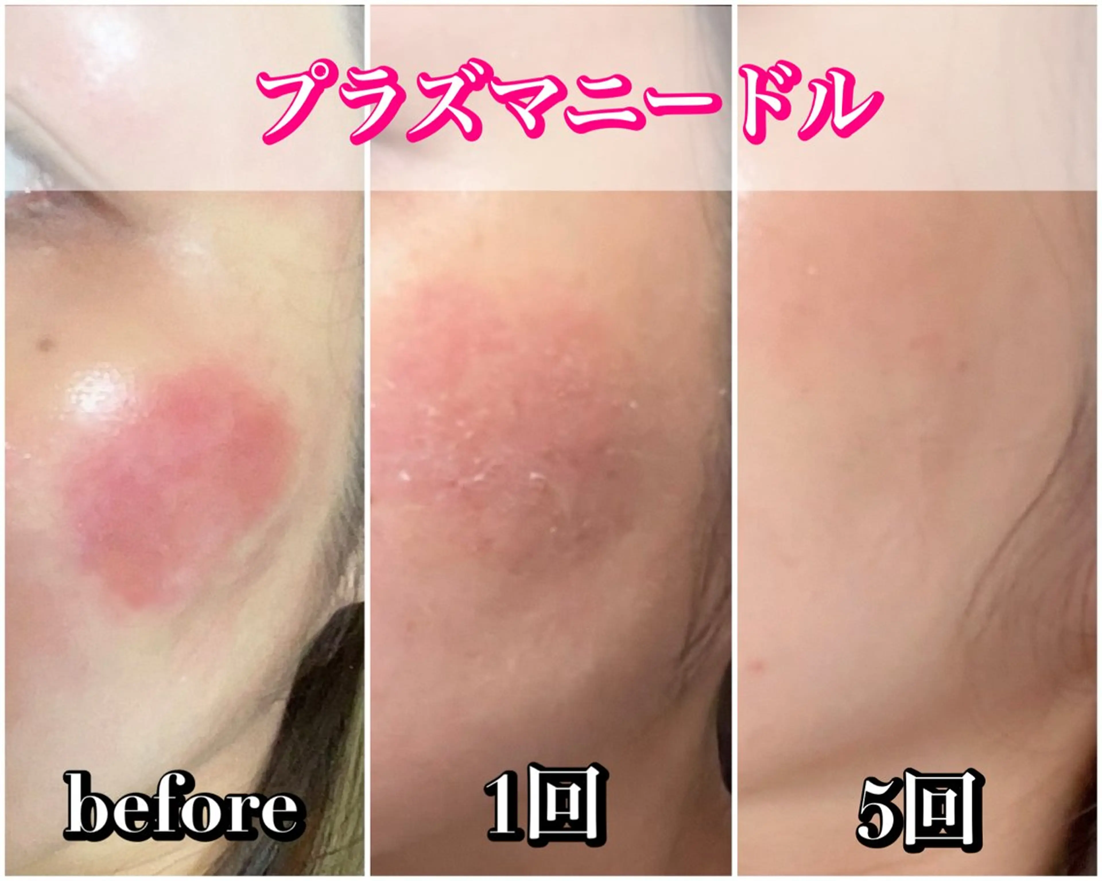 毛穴レス ハーブ＆ ワックス脱毛×光脱毛のエステ・リラクイメージ