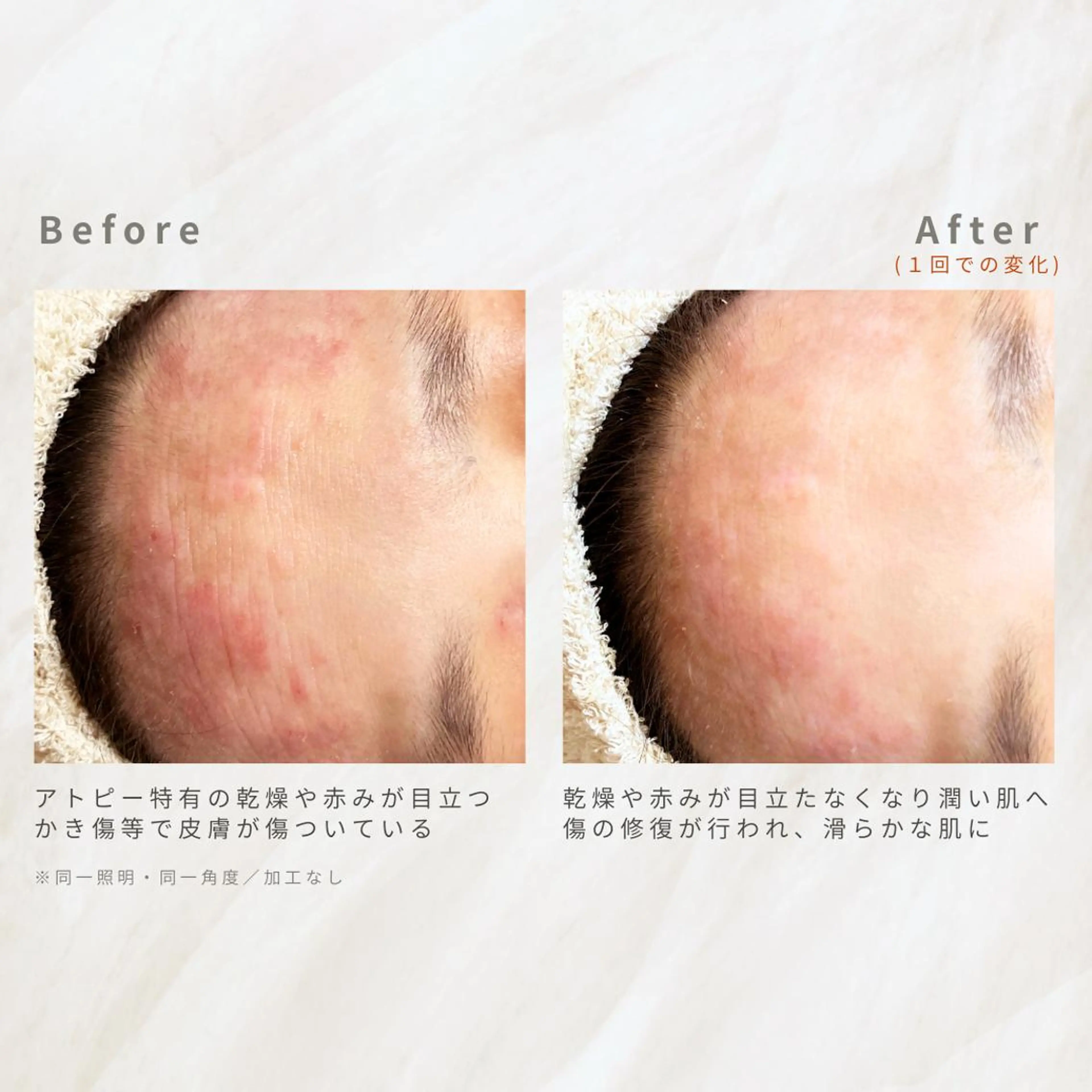 繰り返すニキビ・毛穴 ✨つくば肌質改善専門のエステ・リラクイメージ