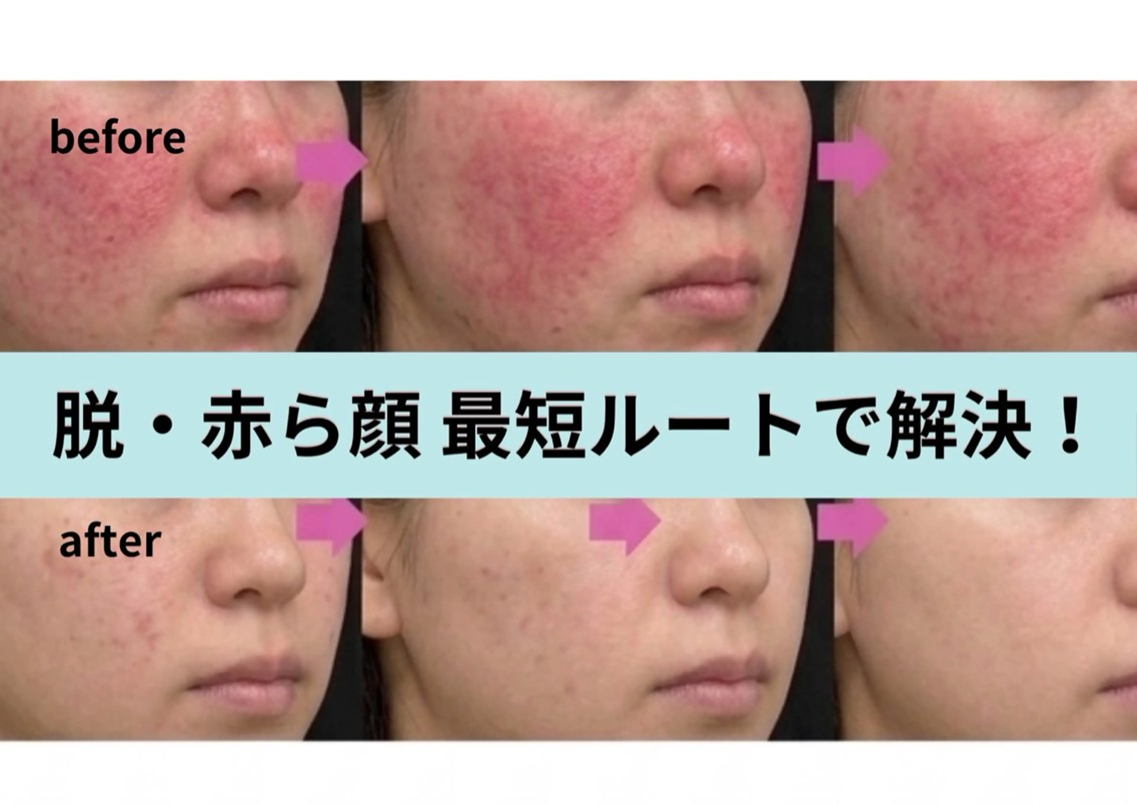 脱・りんご顔🍎【赤ら顔レスな褒められ肌】特殊光×沈静ケアのWアプローチの写真