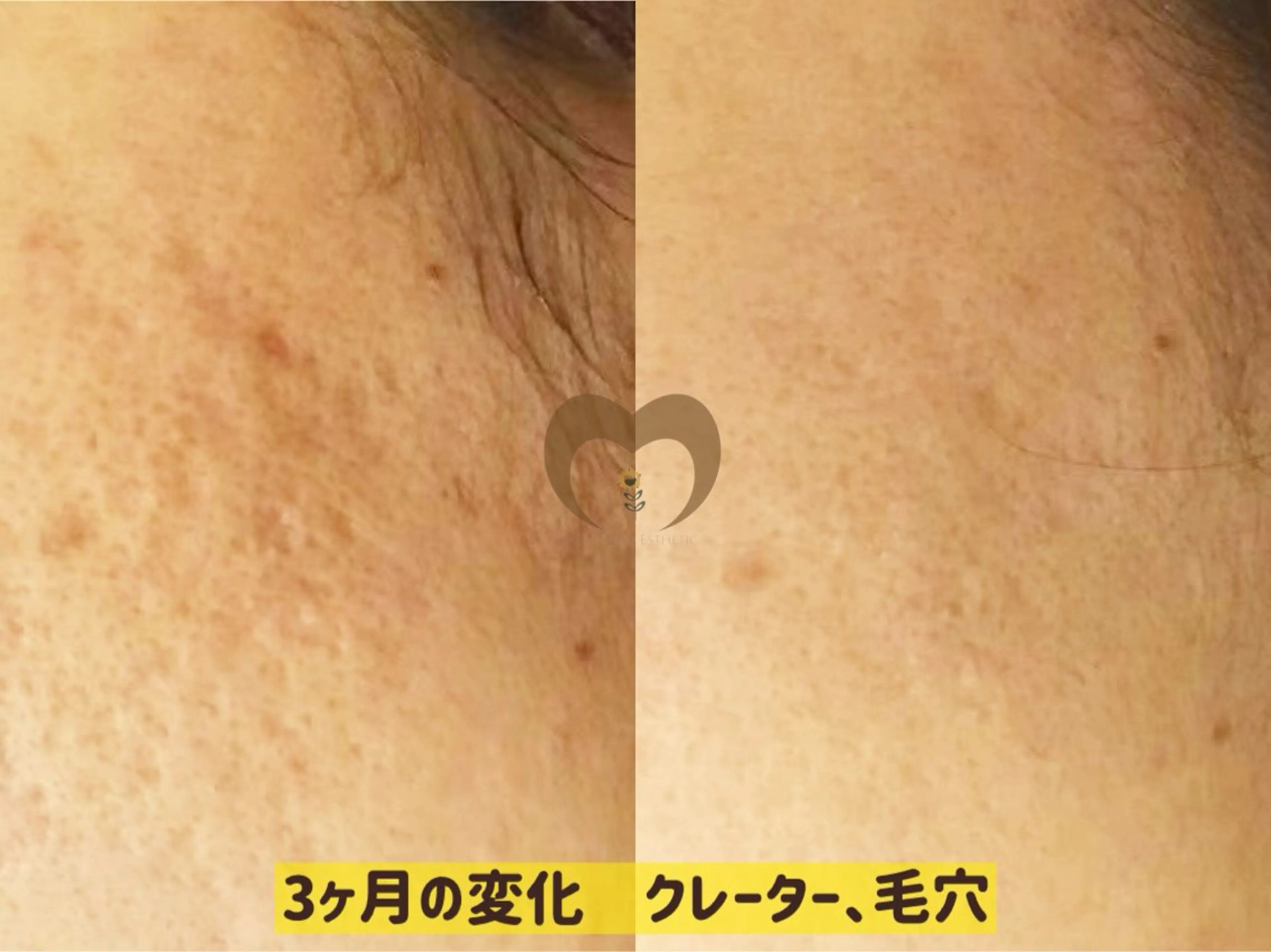 エステ リラク 繰り返すニキビ・毛穴 ✨つくば肌質改善専門のエステ・リラクイメージ