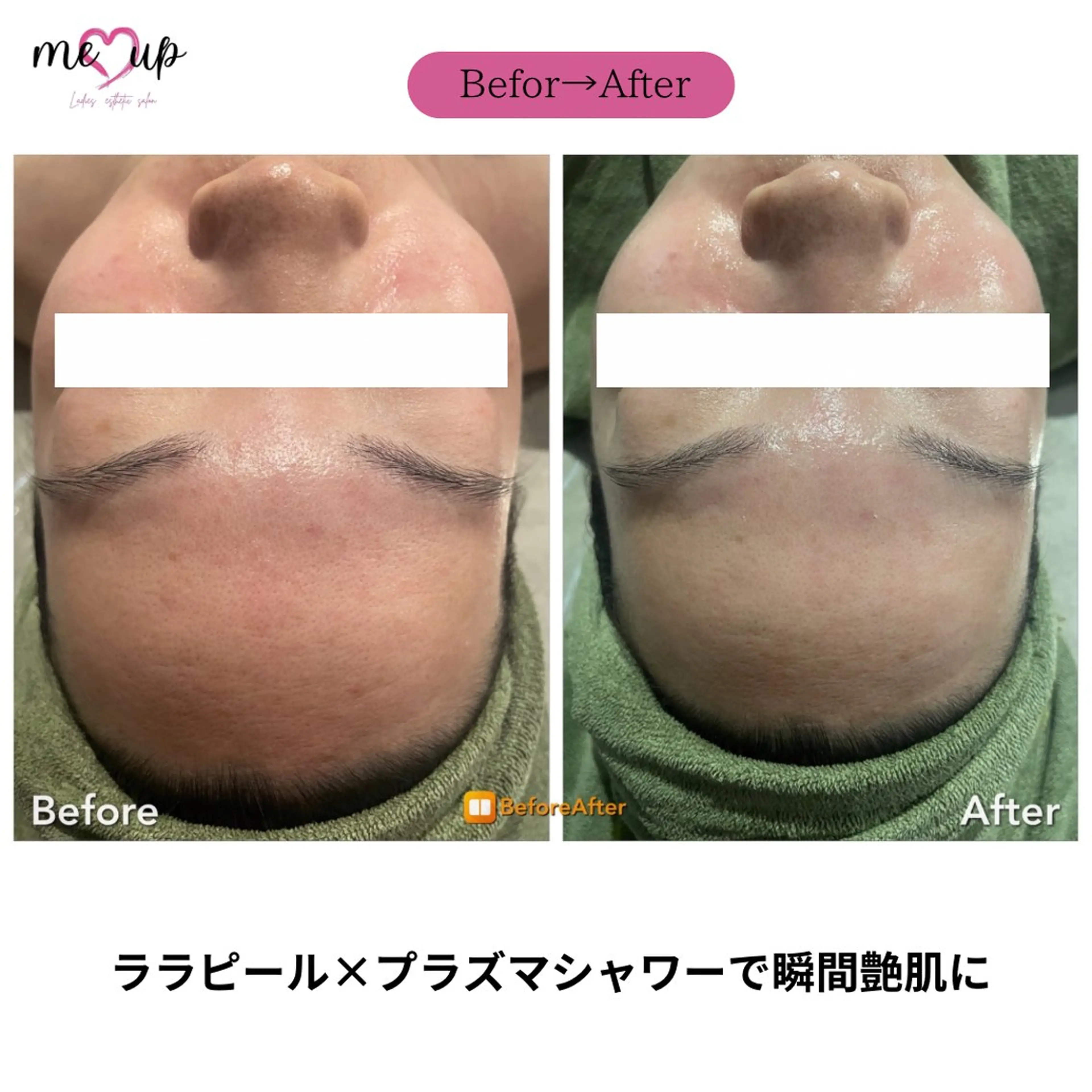 エステ Meupニキビ専門店 背中/ハーブ/肌管理のその他イメージ