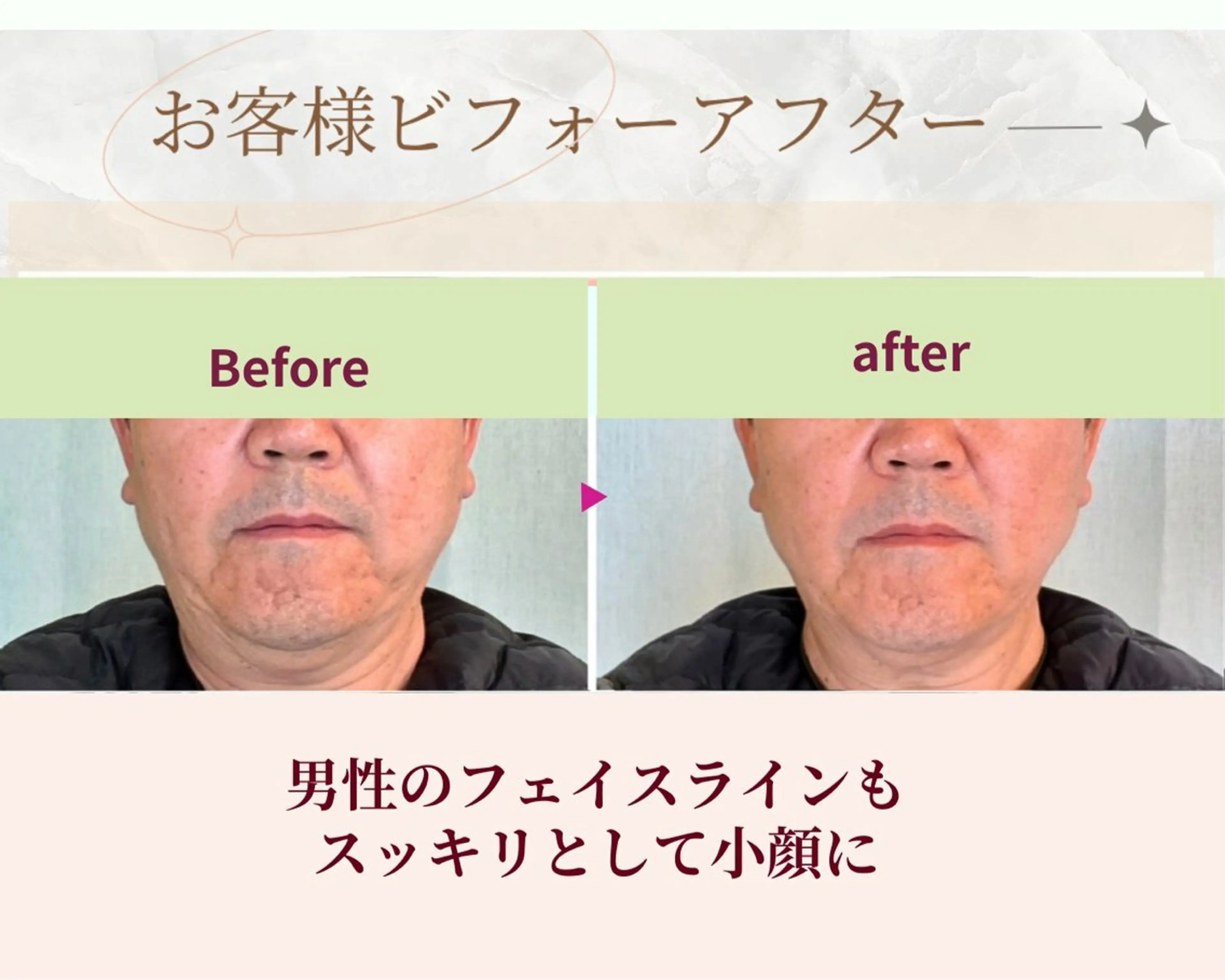 痛くない小顔矯正 いまいあやののその他イメージ