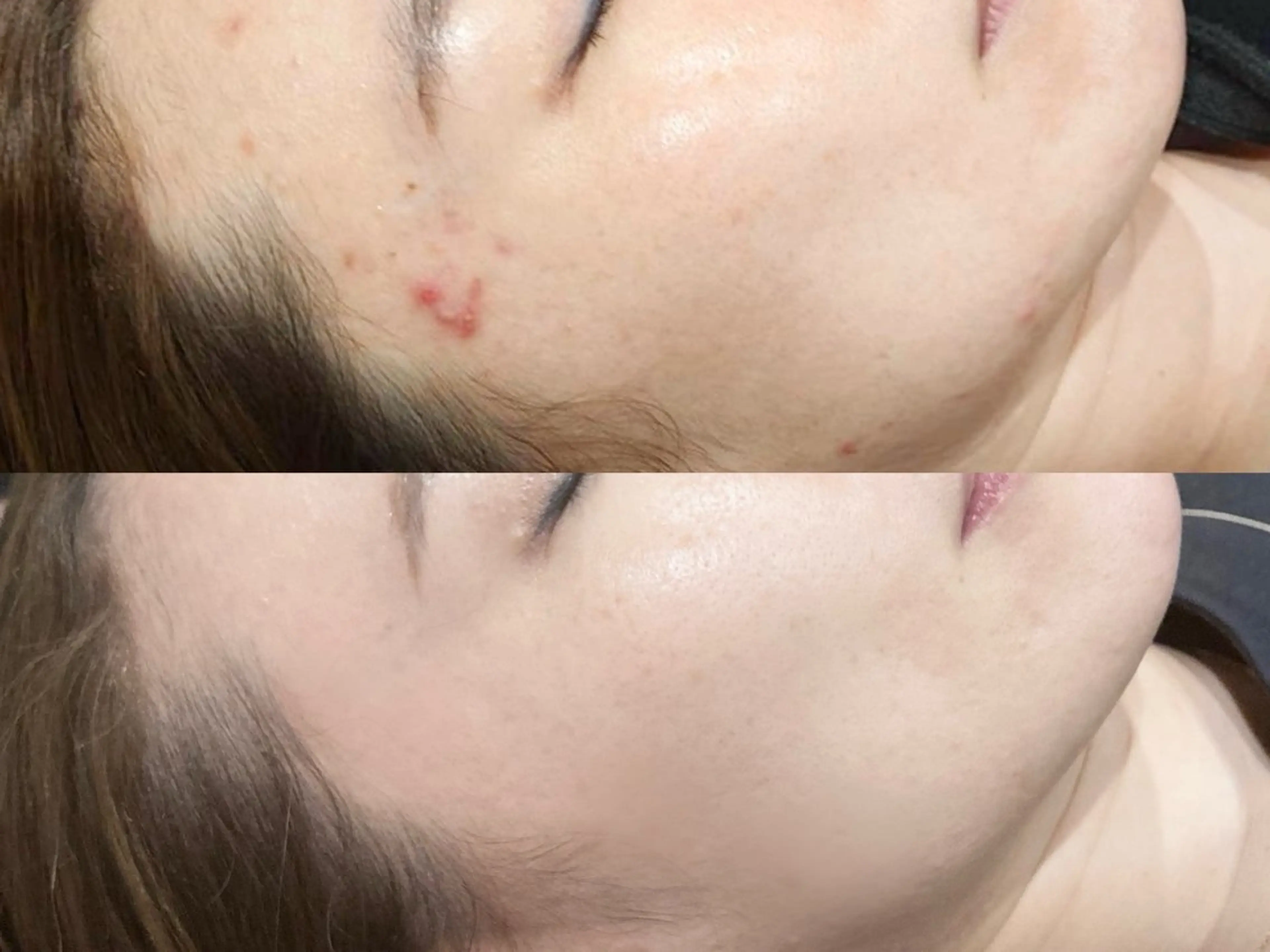 【新規】最先端美肌施術プラズマシャワー照射+美容液導入【ニキビ/肌荒れ/角質ケア】の写真