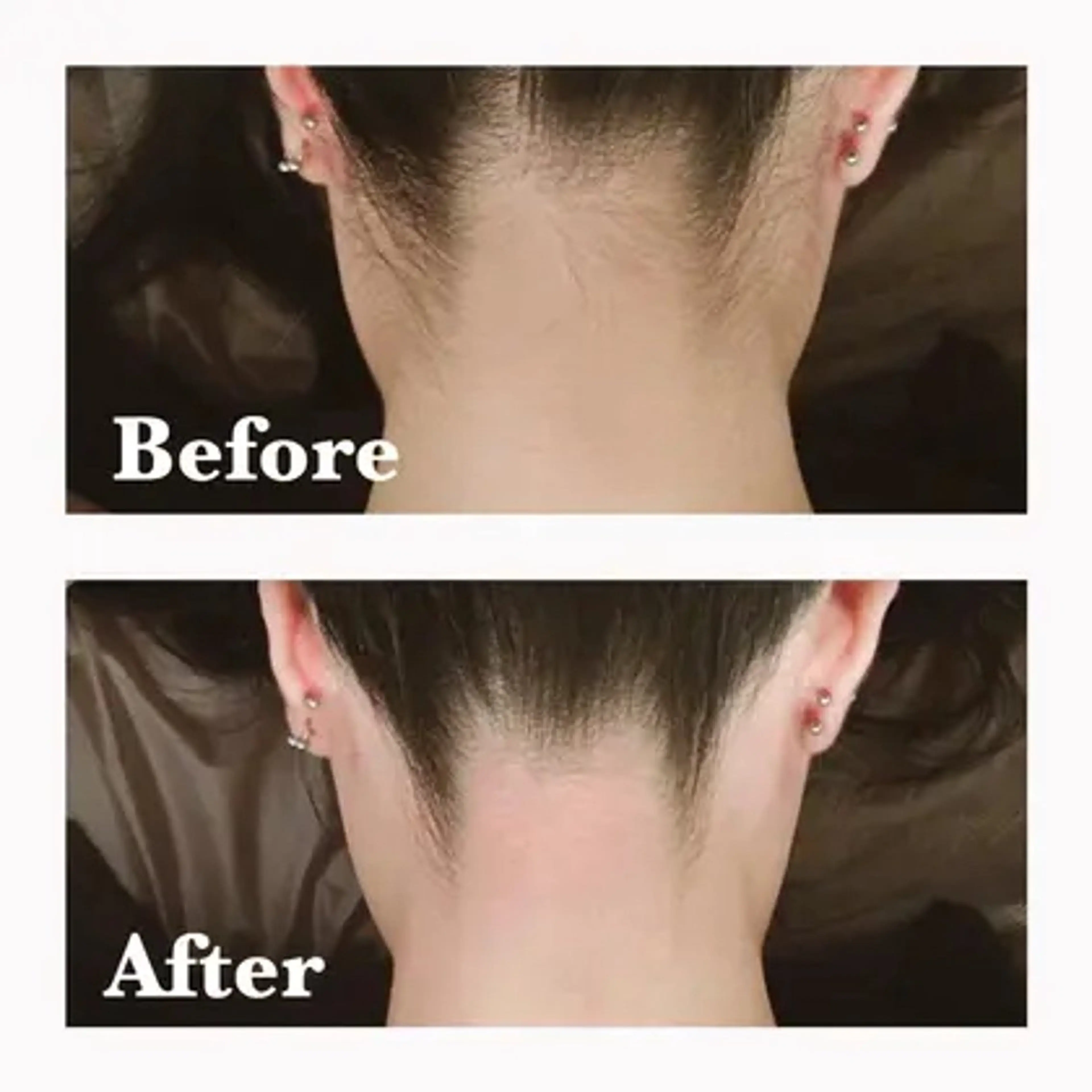 【医療提携】脱毛 小顔ハーブピーリングのエステ・リラクイメージ