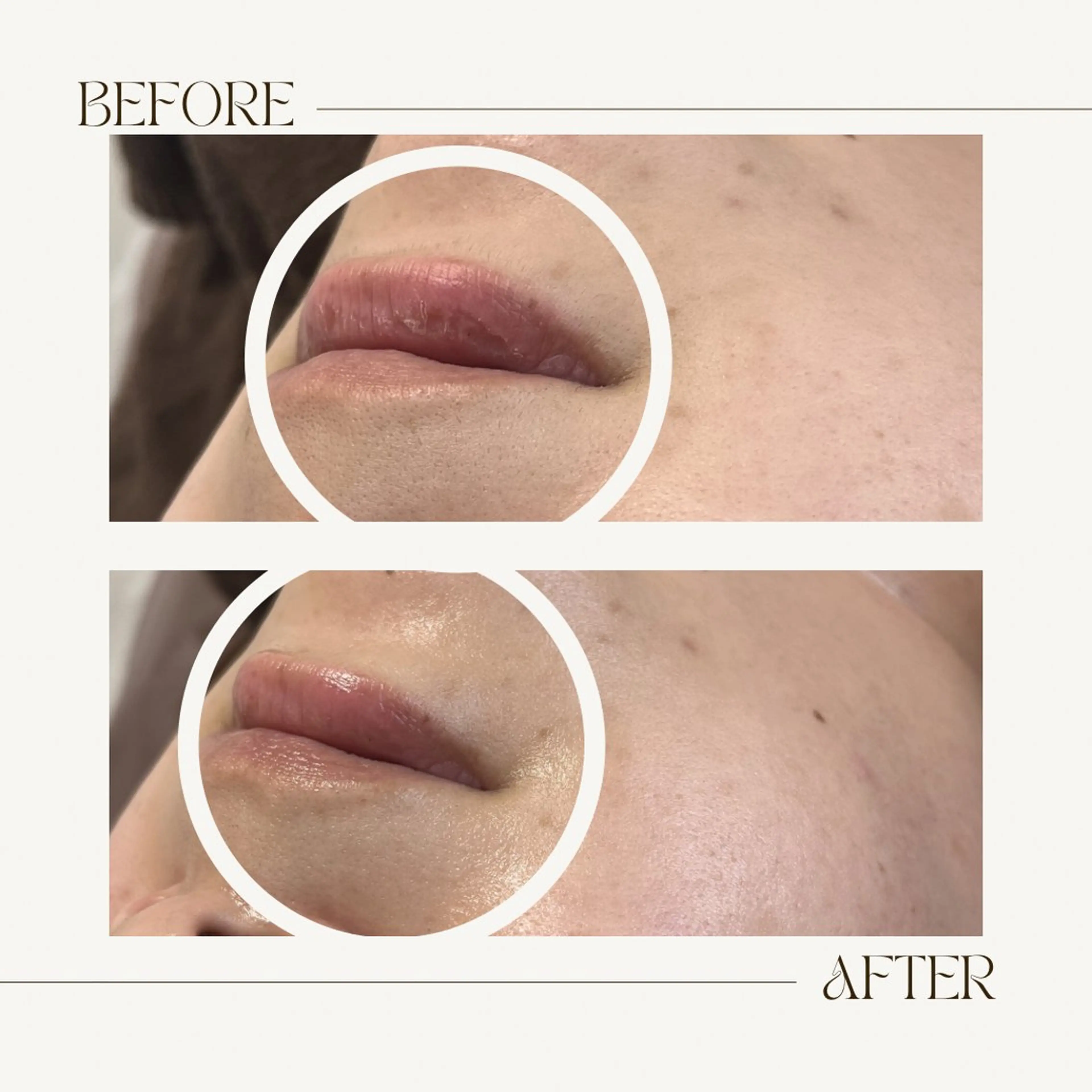 脱毛 1st｜フェイシャル エステ専門店のエステ・リラクイメージ