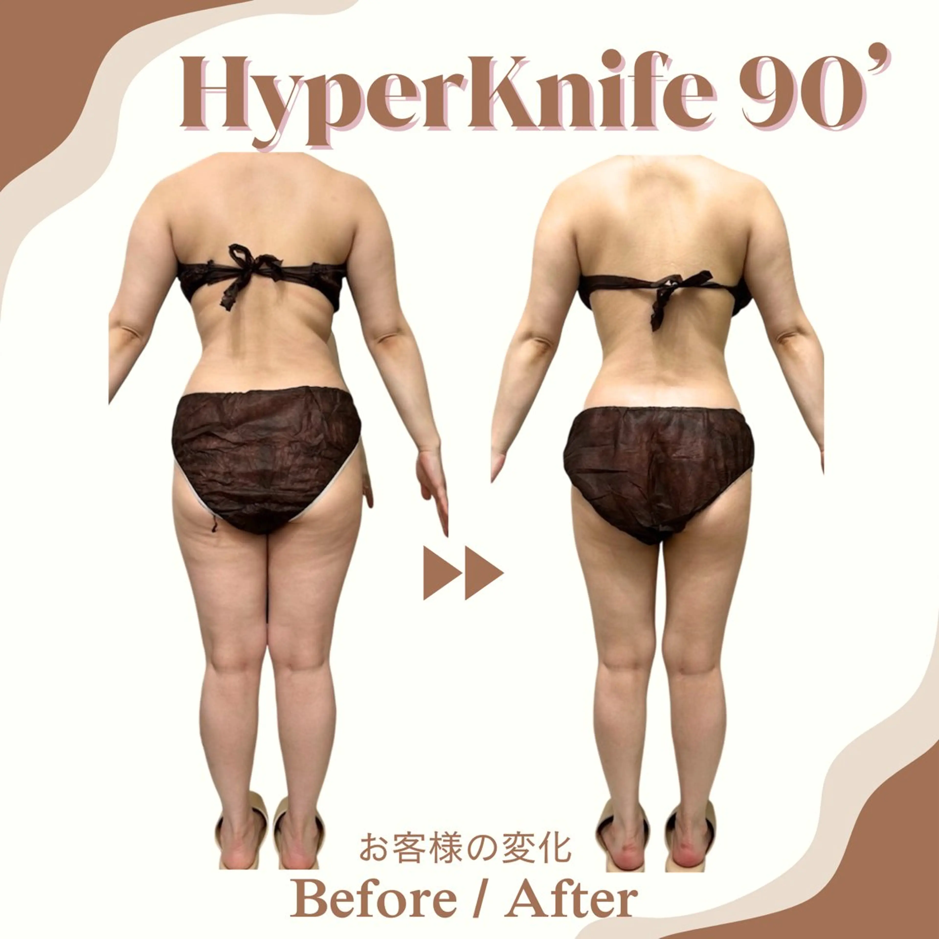 《ミニモ学割》U24 全身ハイパーナイフ90分【デコルテ無し】の写真