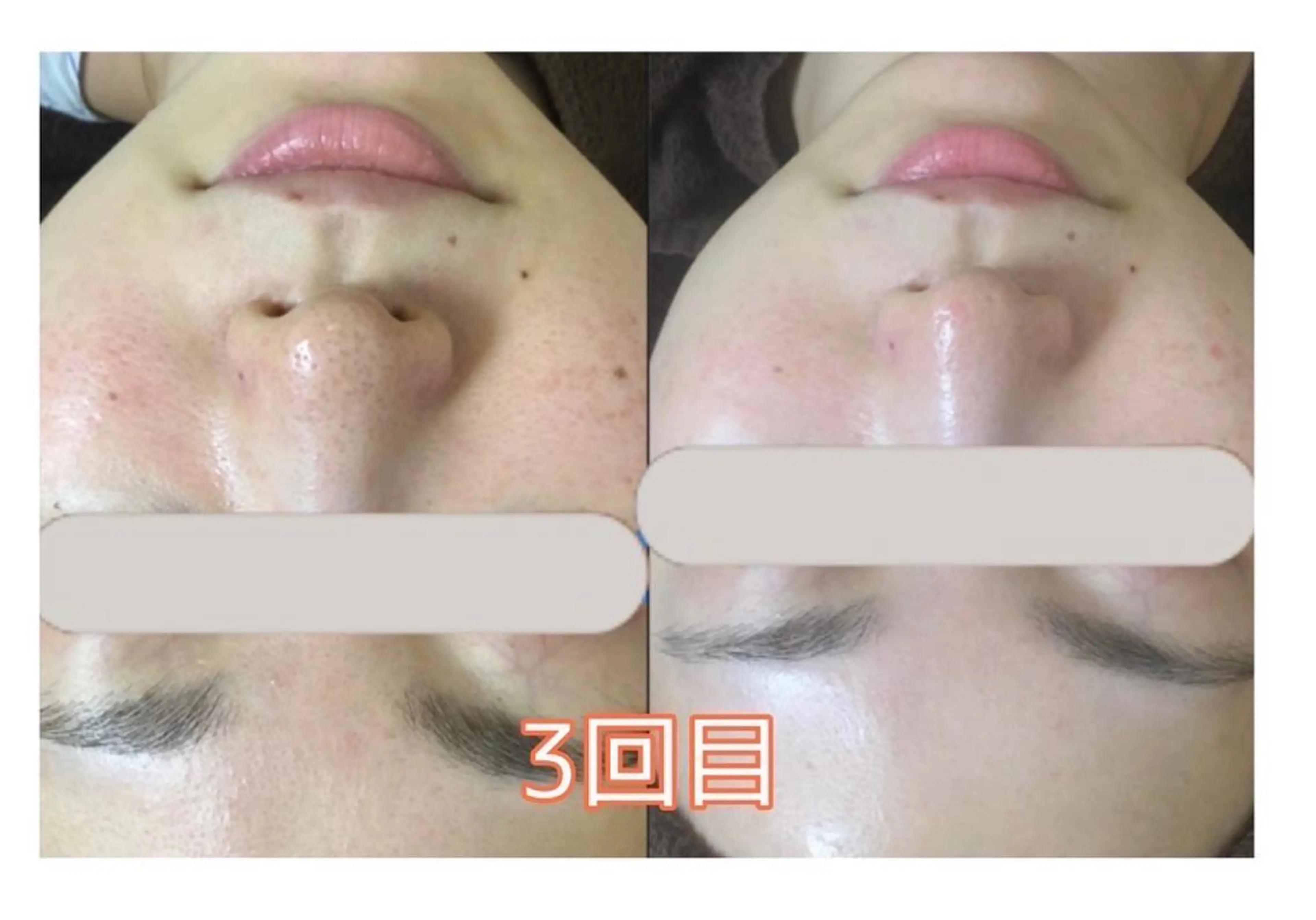 【海外セレブで人気爆発❤️】透明感ある毛穴レス卵肌に♪ハイドラフェイシャル✨の写真