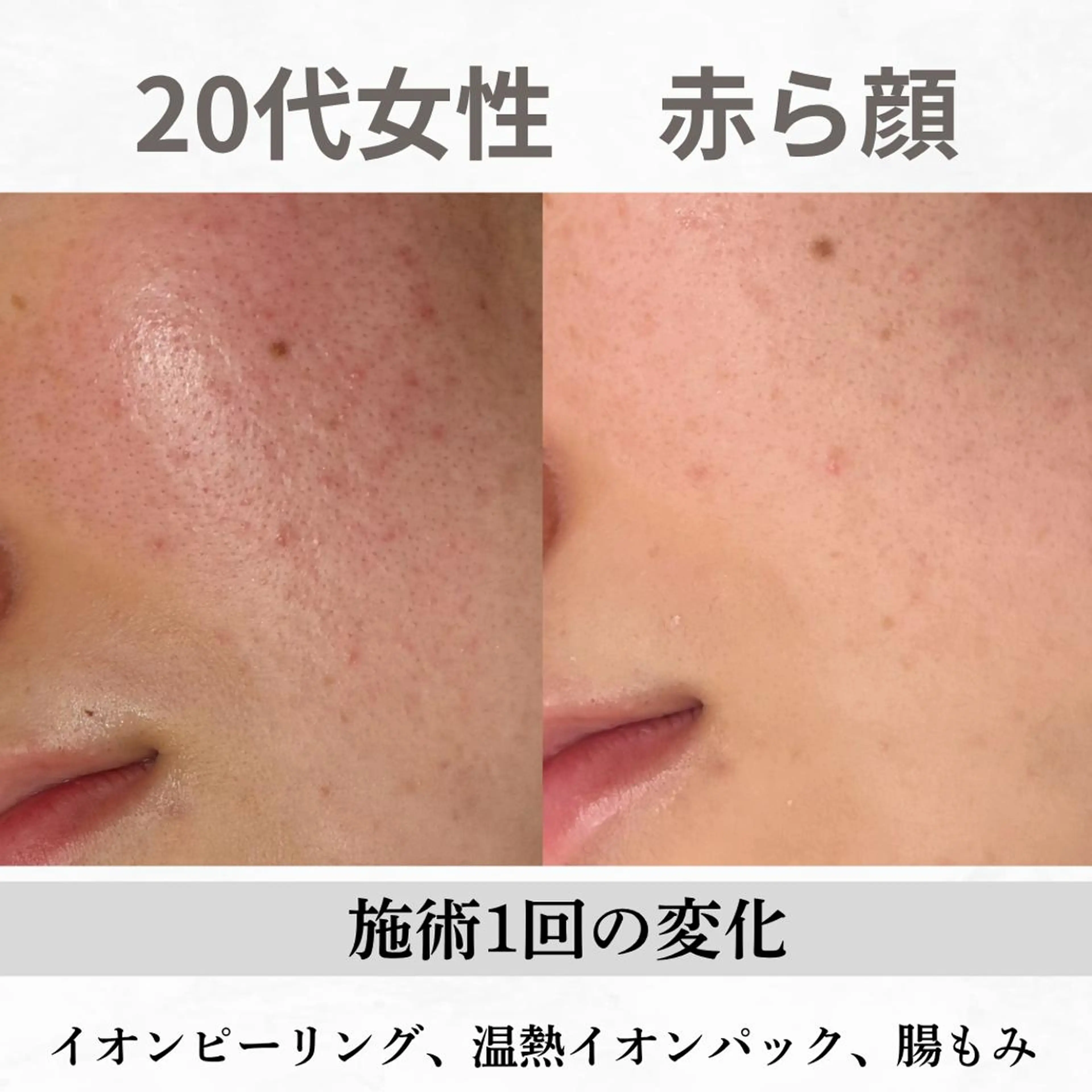 重度ニキビ専門🌷 ダウンタイムなしのエステ・リラクイメージ