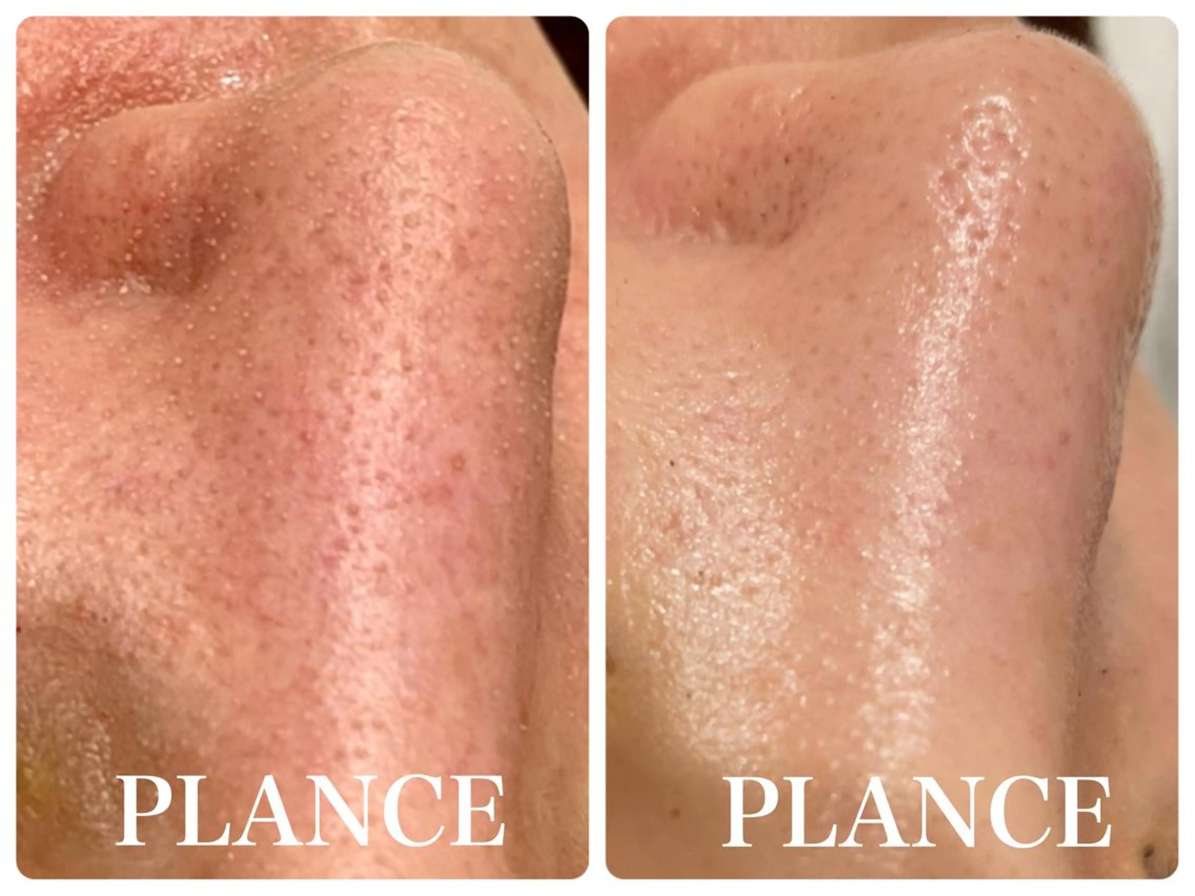 エステ フェイシャル専門 肌質改善/プランスのエステ・リラクイメージ