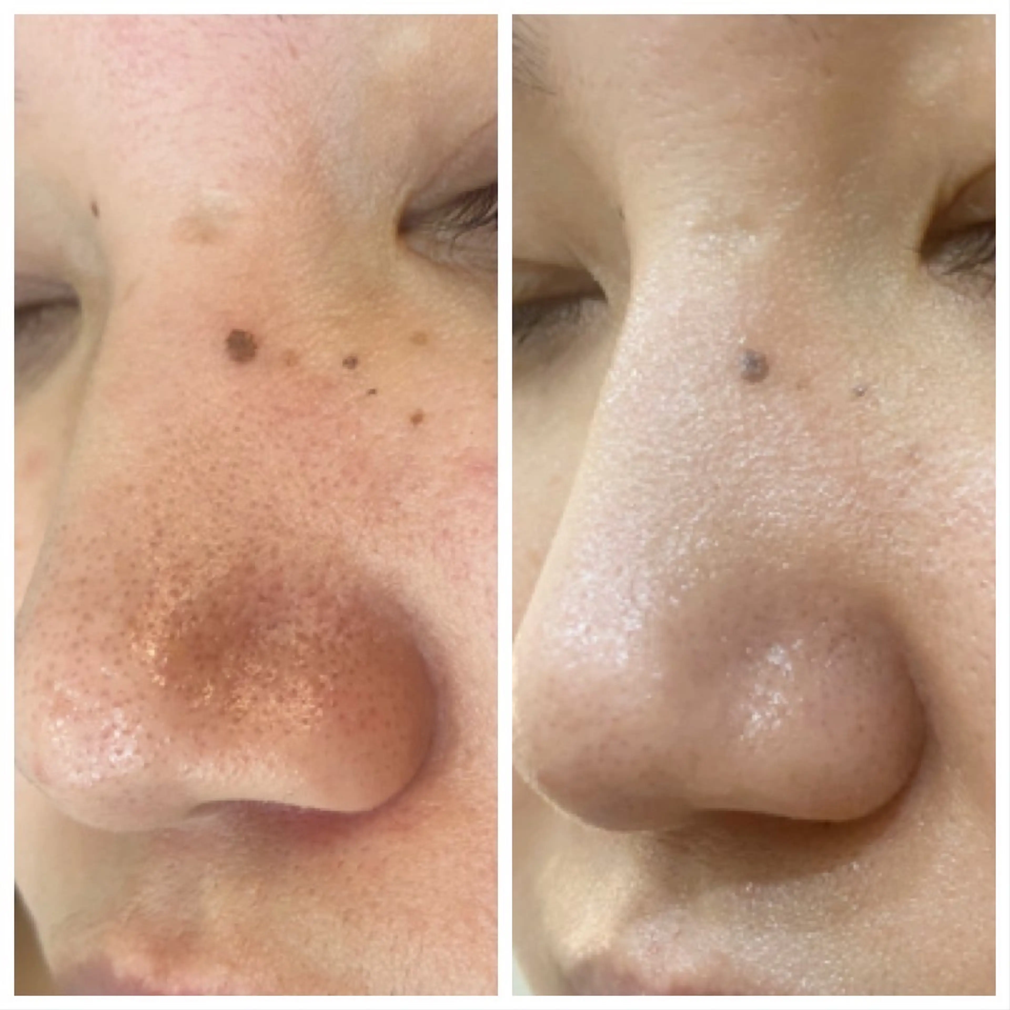 ダウンタイムなし！痛みなし！ハーブピーリングの写真