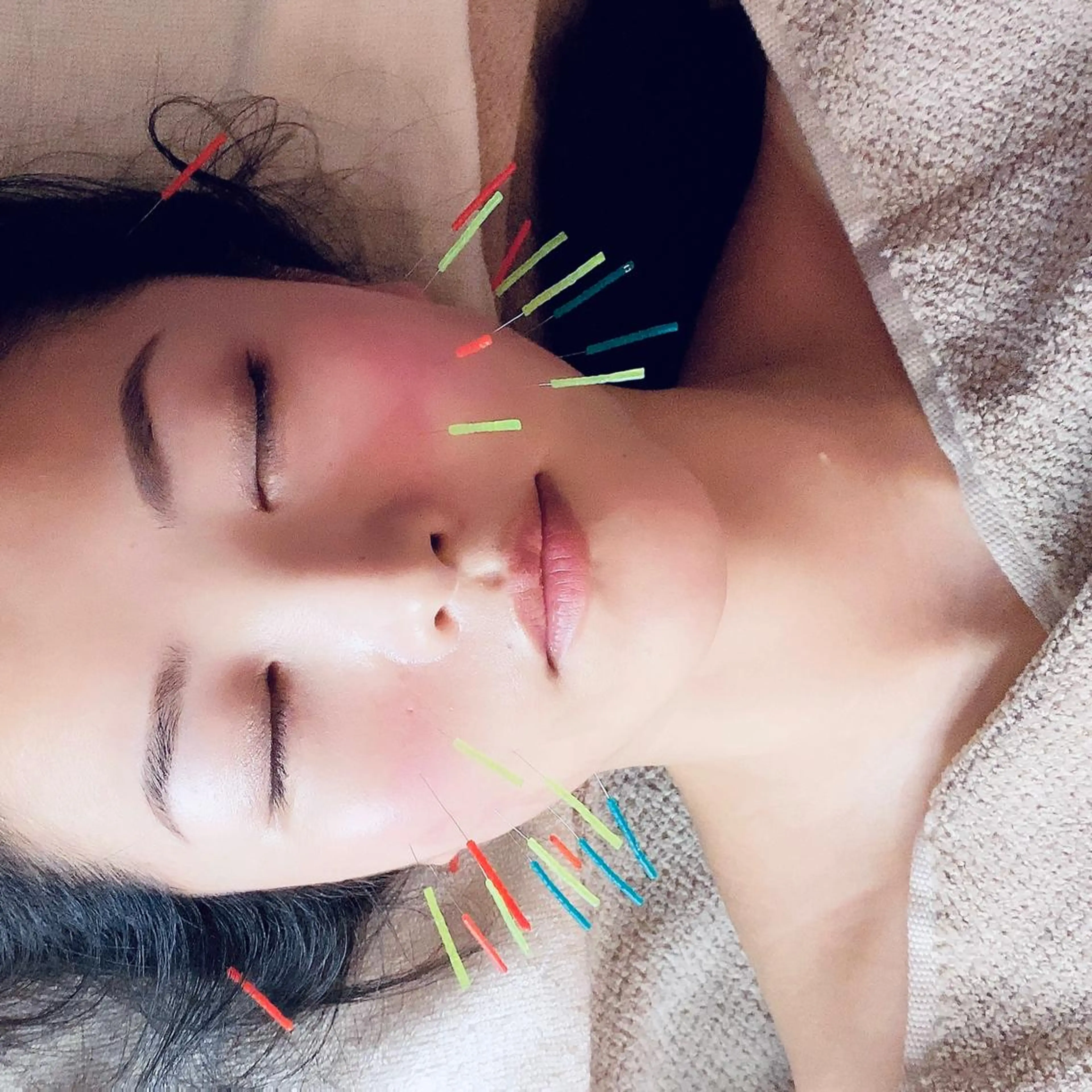 【小顔鍼40分】美容鍼&低周波+ドライヘッドスパの写真