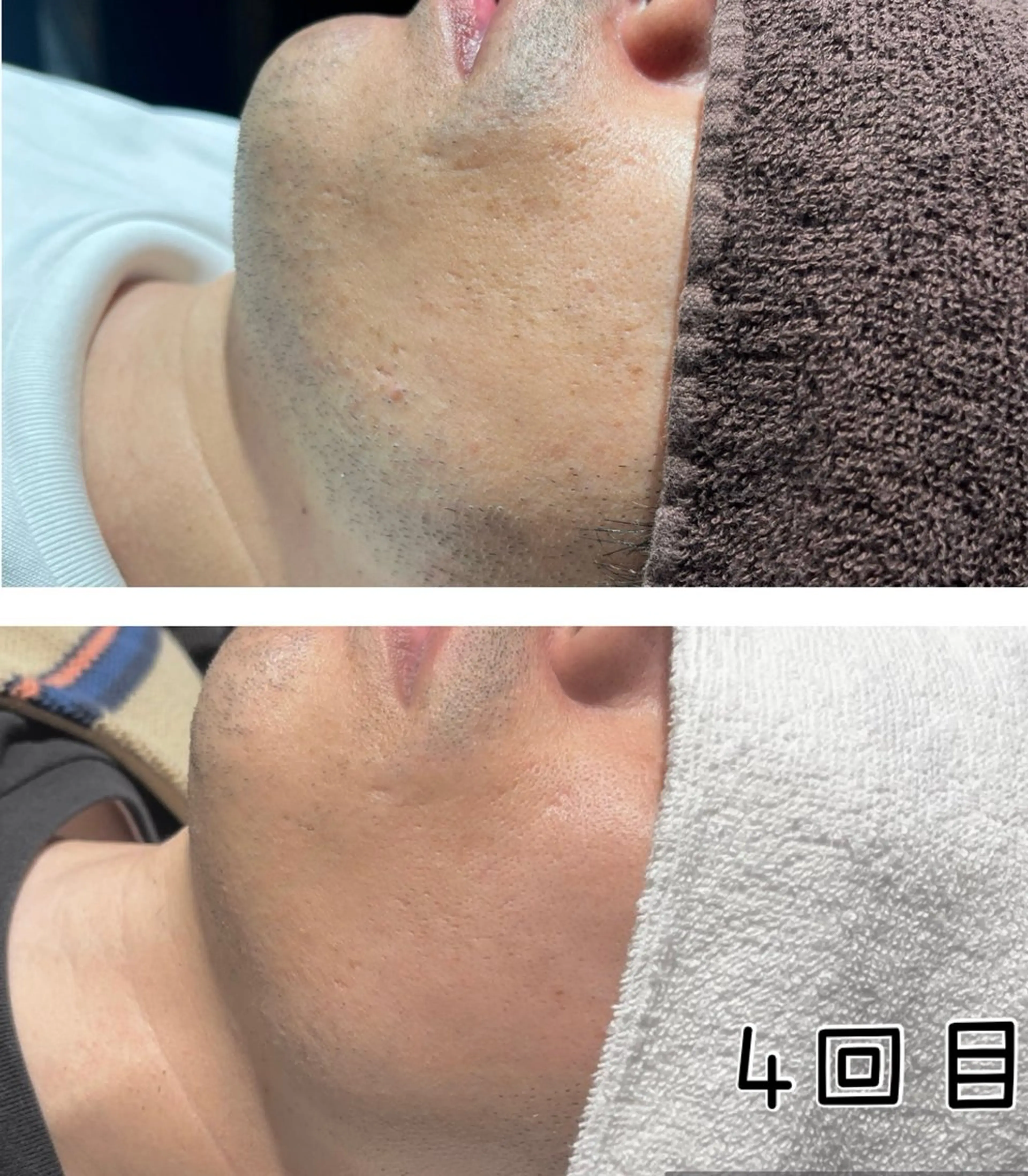 丸ごと全部ヒゲ脱毛【6回コース】‼️メンズ専用✨新規も再来もみんな使えるお得なクーポン🥸‼️の写真