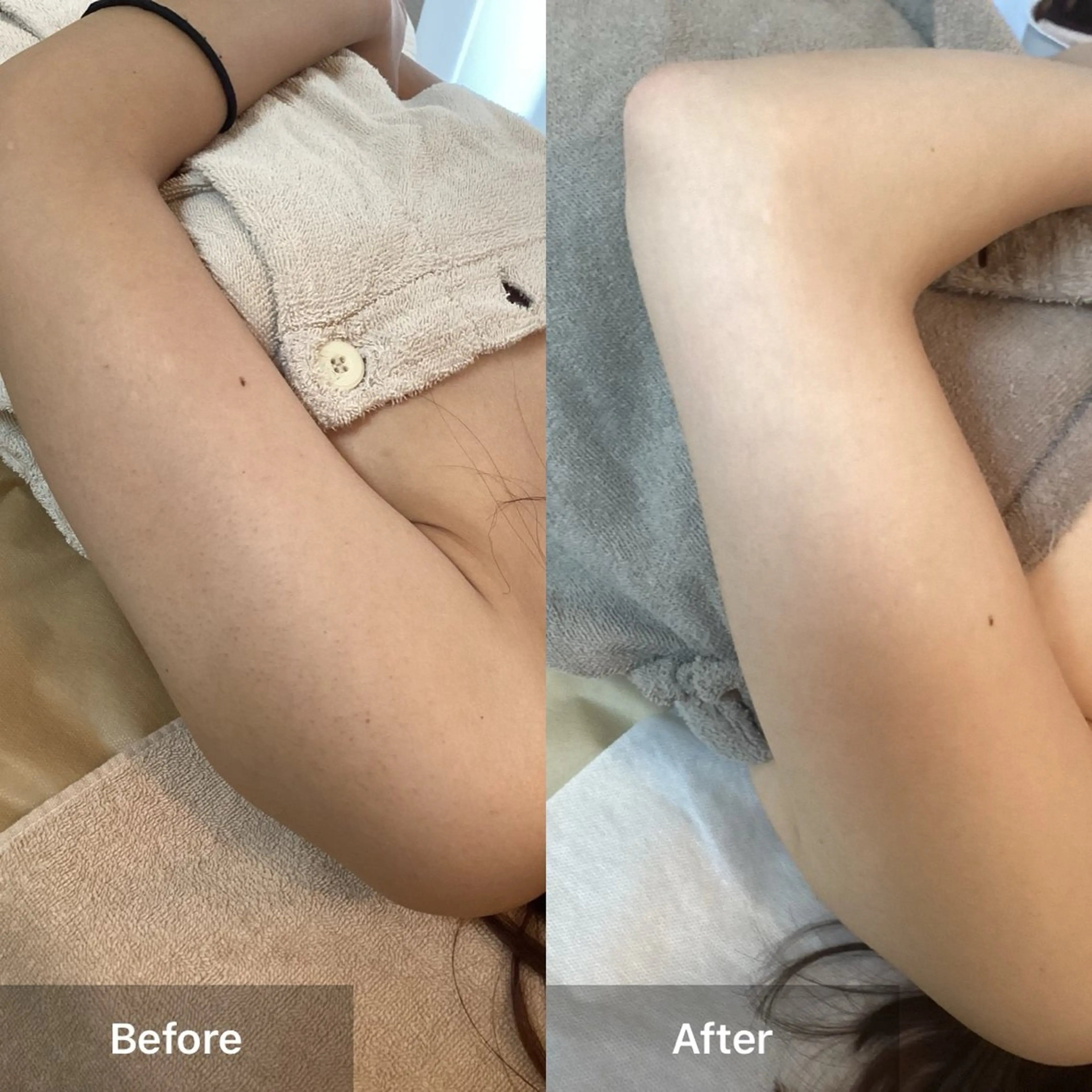 🌿何を試しても効果なかった二の腕のブツブツ✨/毛孔性苔癬/ブツブツ/毛穴/黒ずみ/ニキビ/ニキビ跡/肌質改善の写真