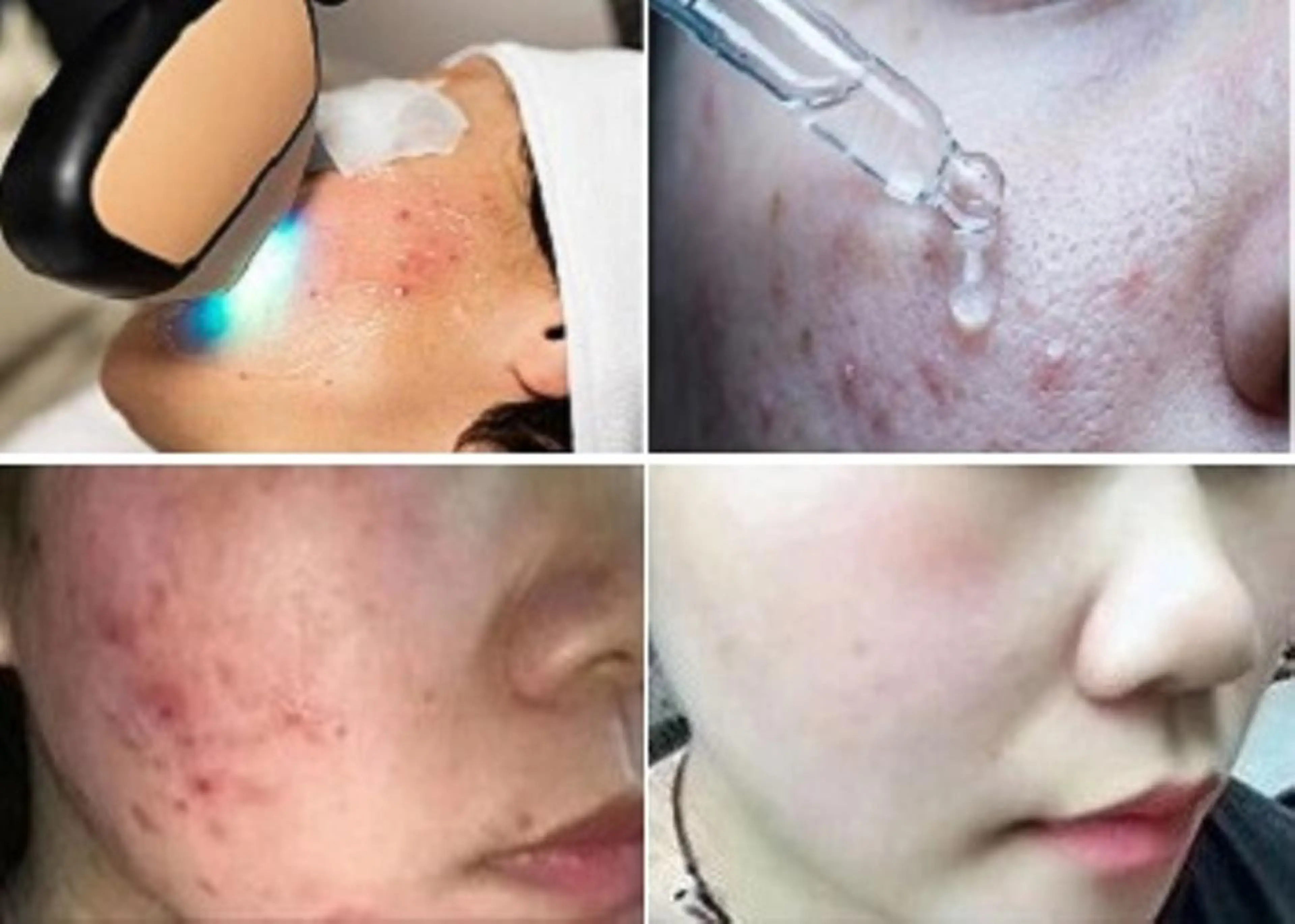 エステ 顔脱毛＆毛穴＆ニキビ 優良№1♪ヒロコ♪のエステ・リラクイメージ