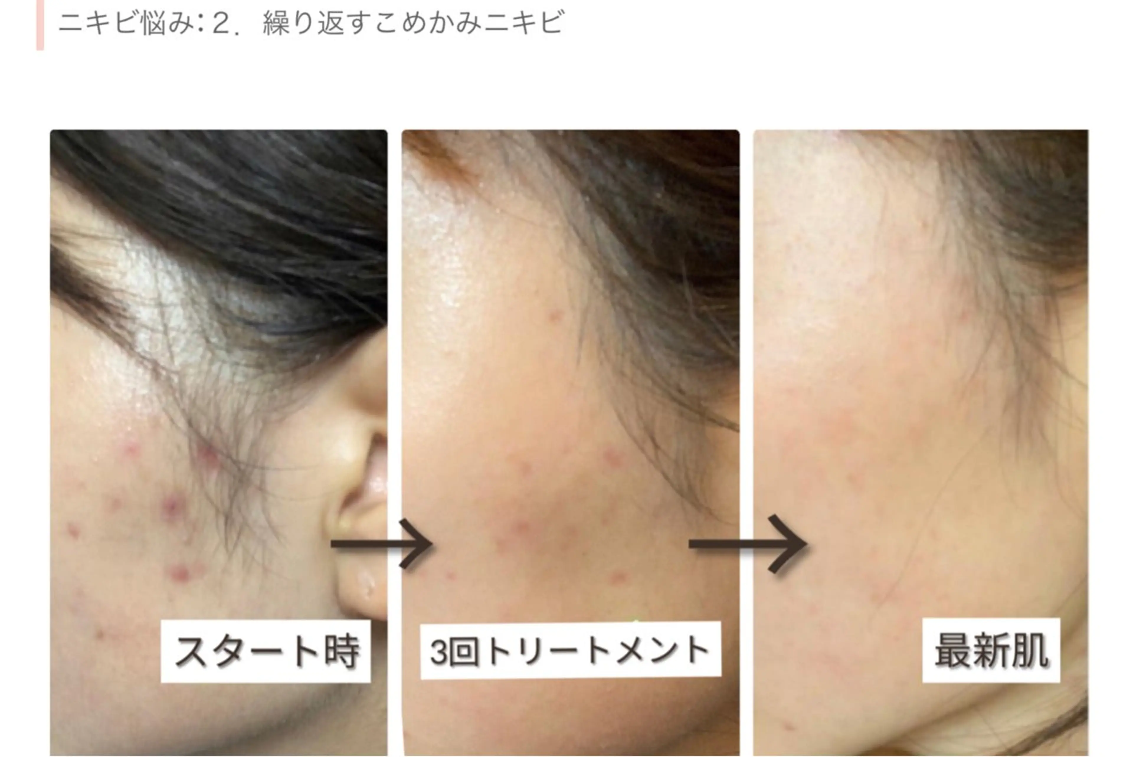 エステ ☺ハーブピール💕 ソフィアカロン💖のエステ・リラクイメージ