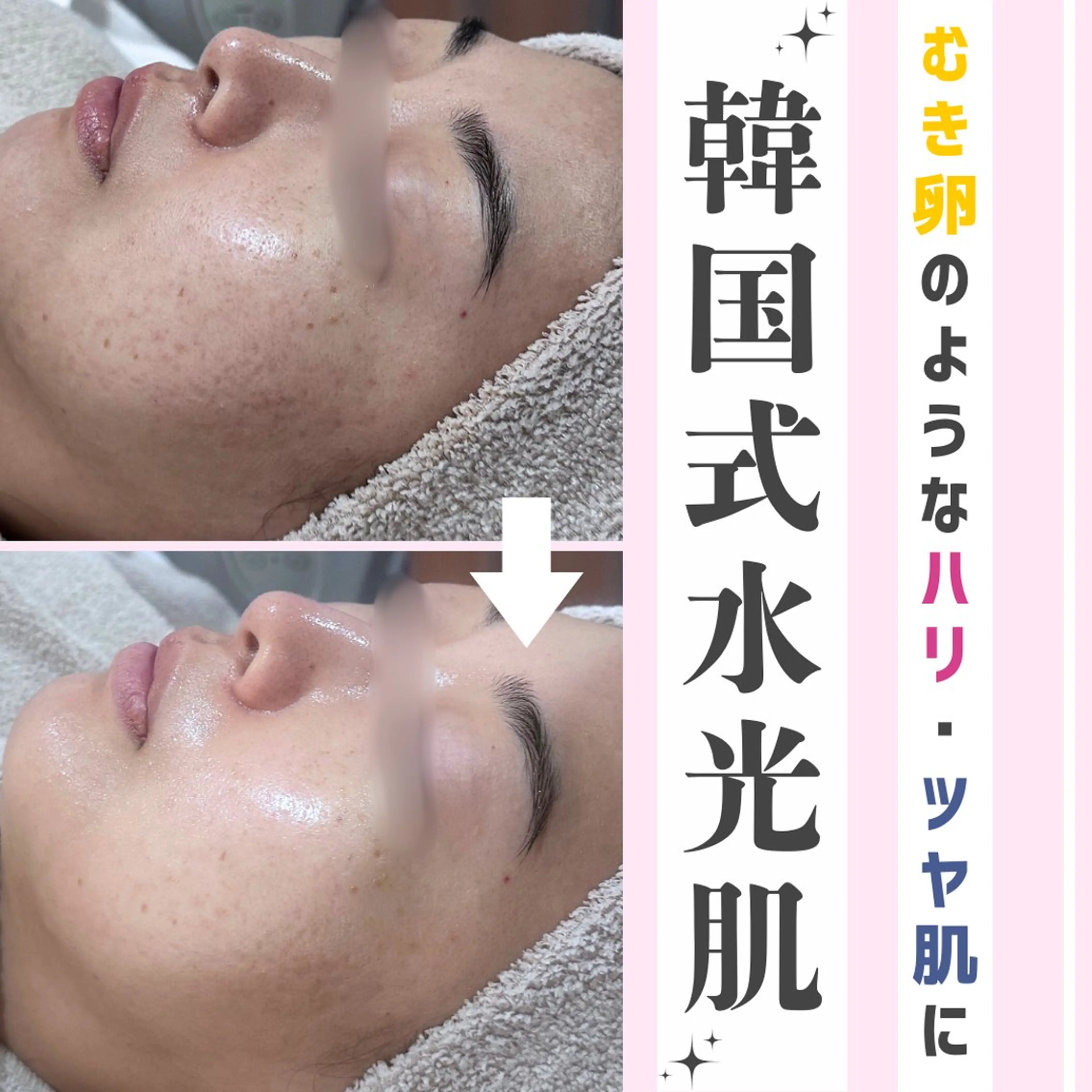 人気NO.1🤍〈ツヤツヤ水光肌〉水光肌ピーリング (剥離&ダウンタイムなし) 60分5,000円の写真