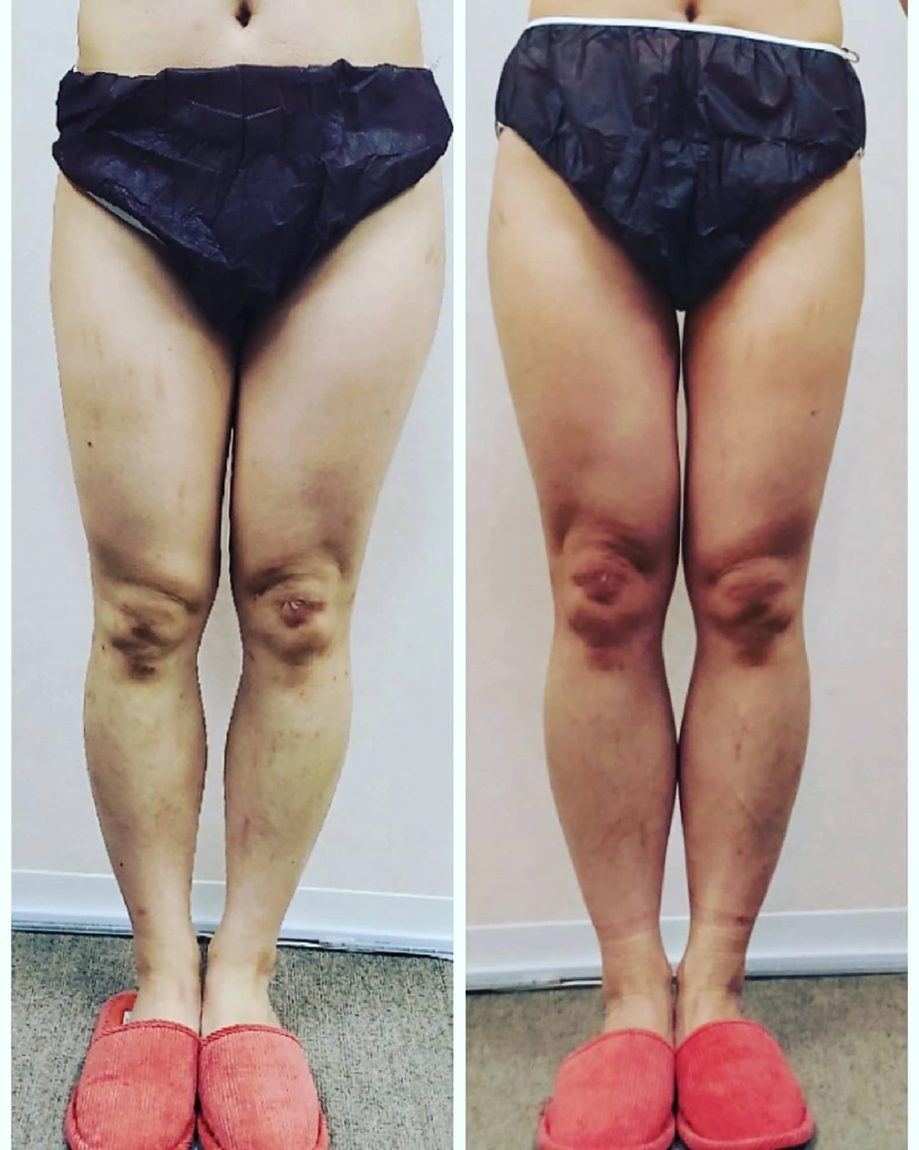 【痩身】特許取得のWキャビテーション＆超音波で脂肪が溶けて流れて更に筋肉を引き締めます！の写真