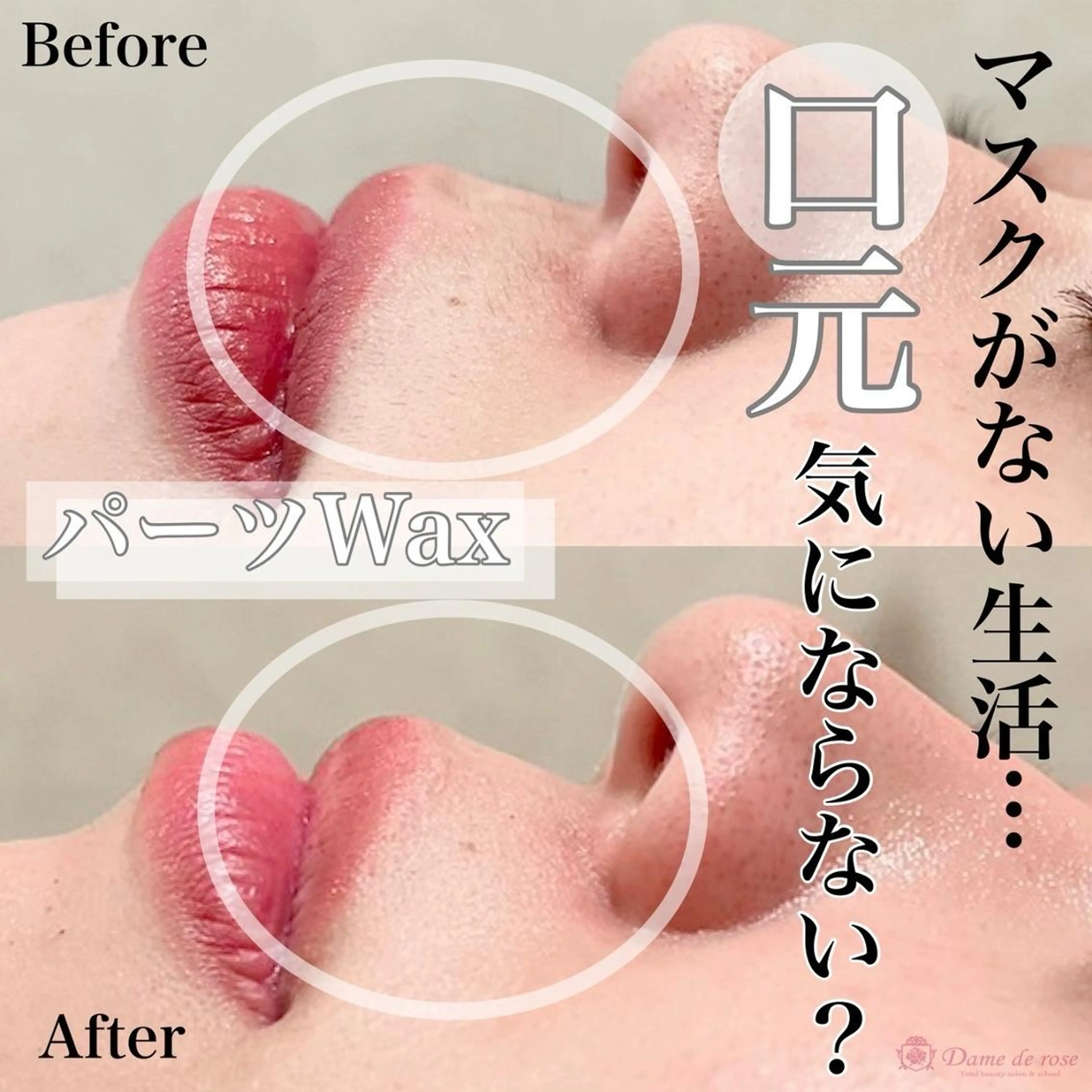 【Wax脱毛】1パーツの写真