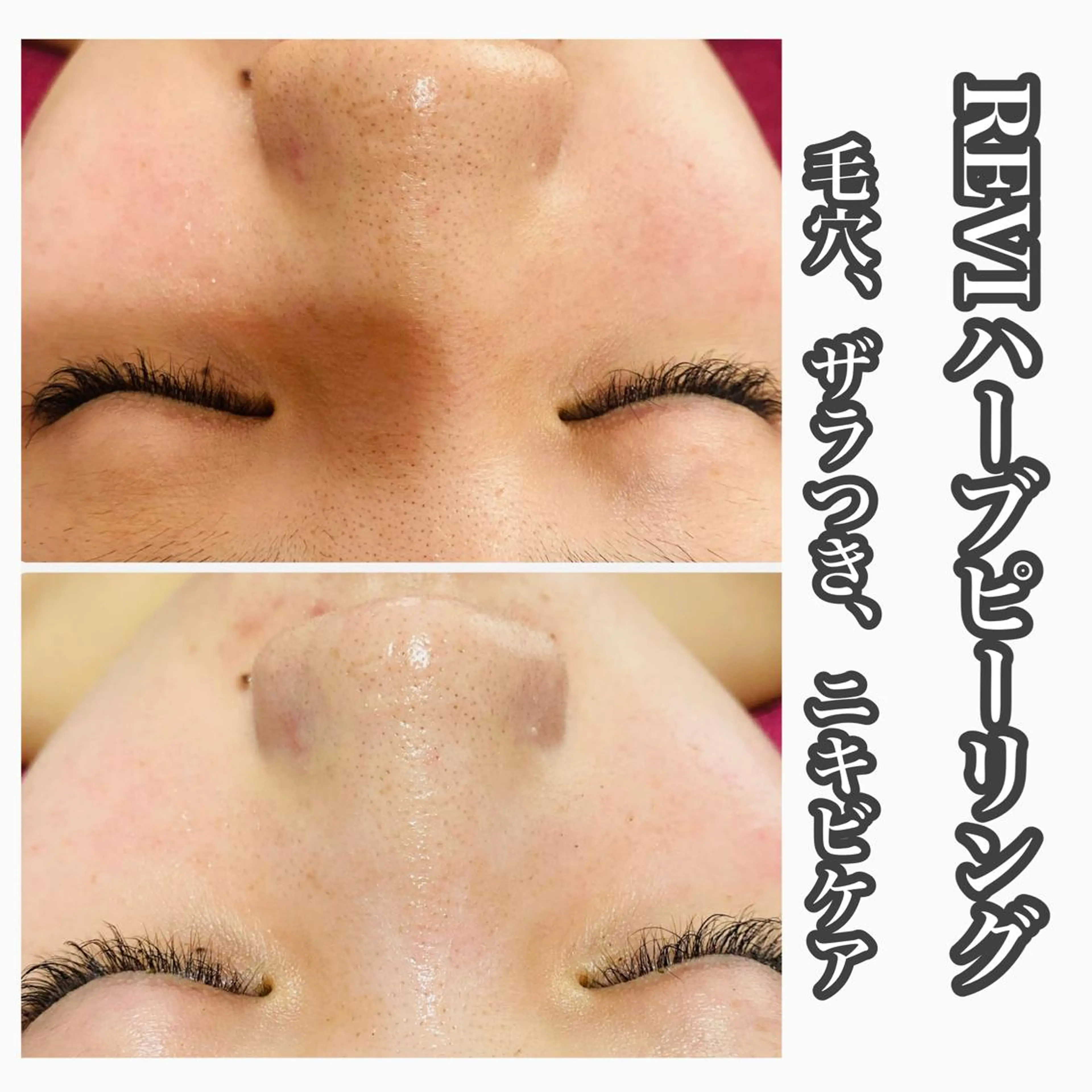 Chalon所属・REVI取扱・肌悩み 毛穴Chalonのエステ・リラクイメージ