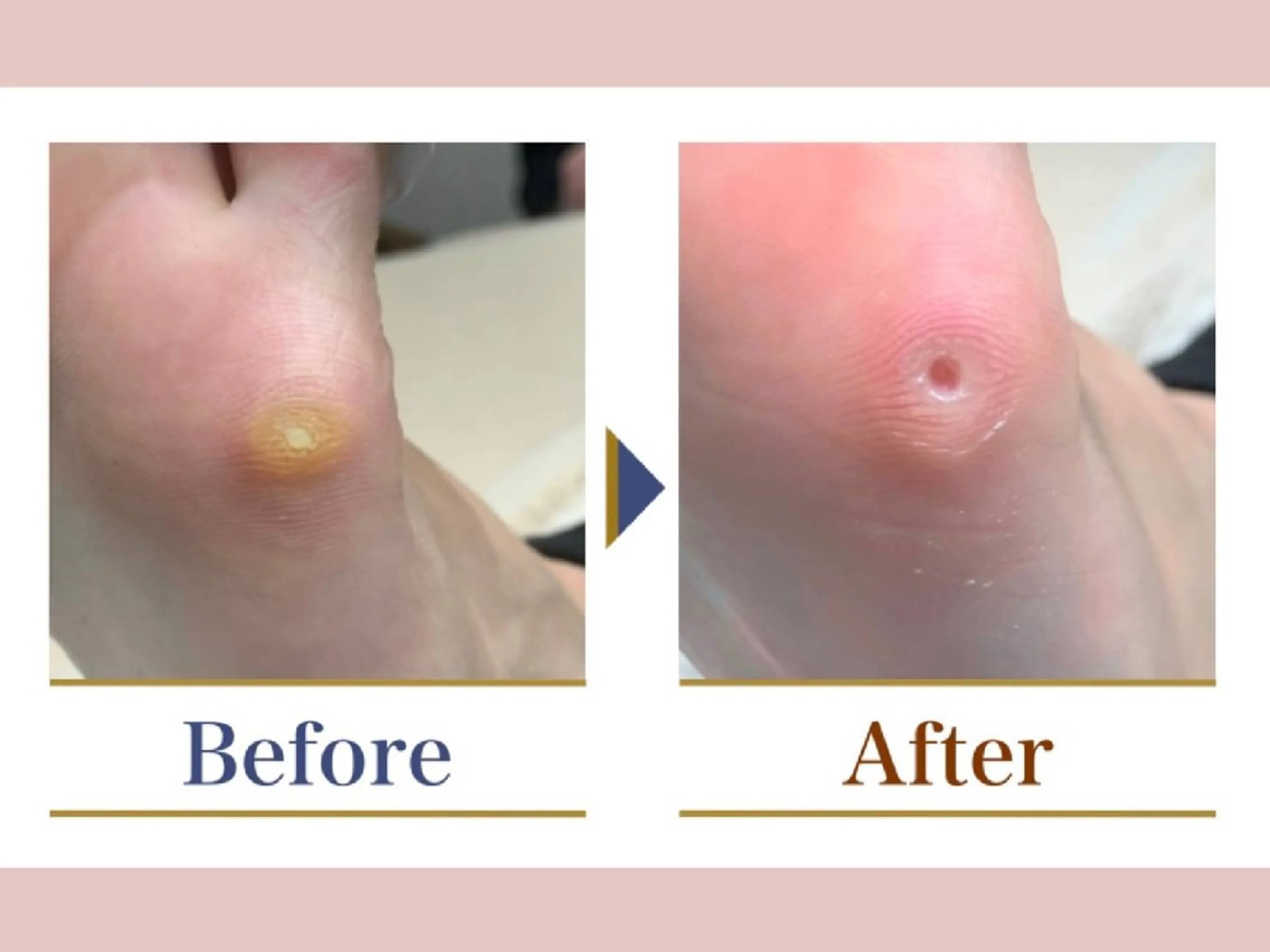 タコ・魚の目（上部）痛い魚の目、硬くて不快なたこを一度で、スッキリ取り除きます。お痛みの少ない施術です。の写真