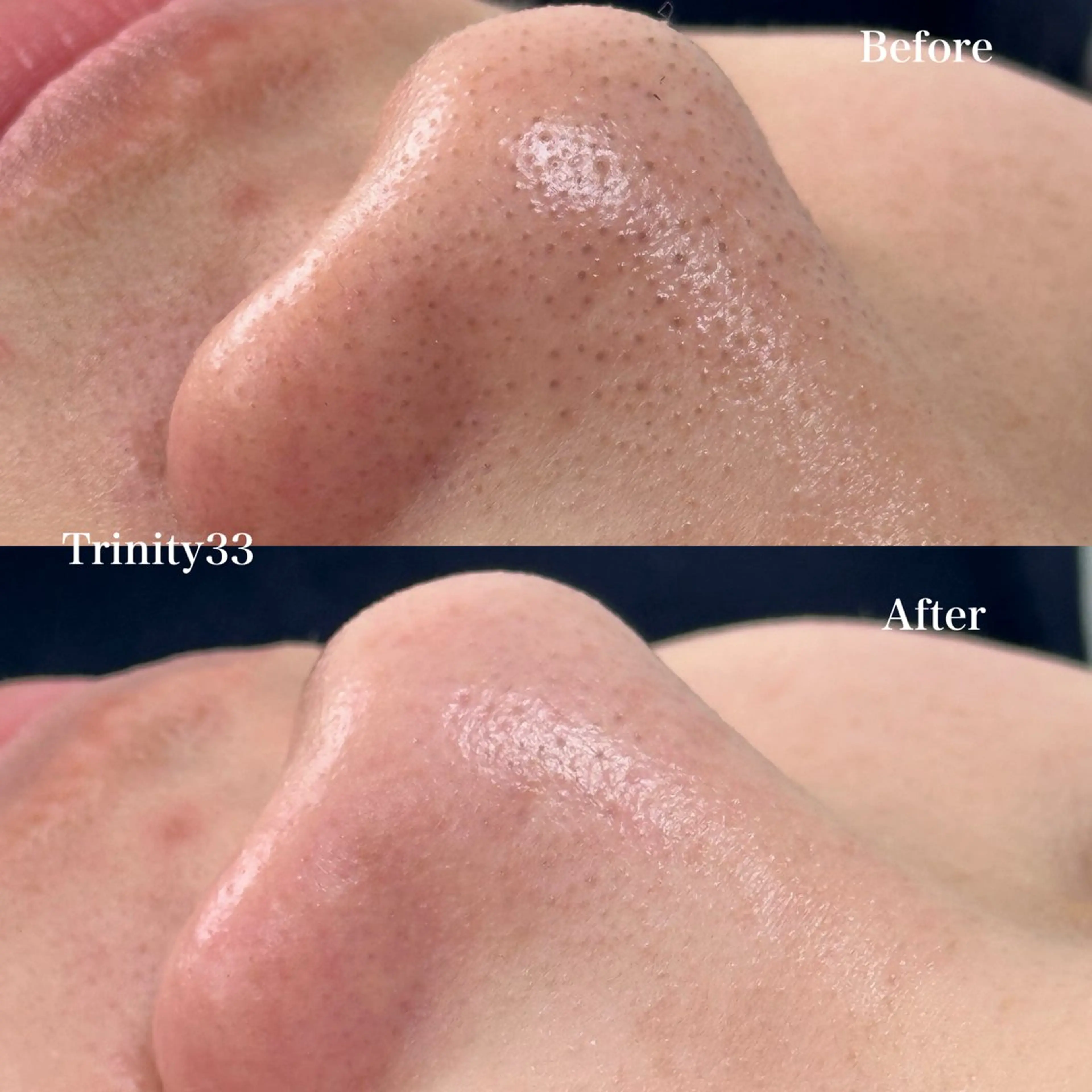 【毛穴洗浄】黒ずみ/開き毛穴/いちご鼻一発解消!!6800→5800の写真