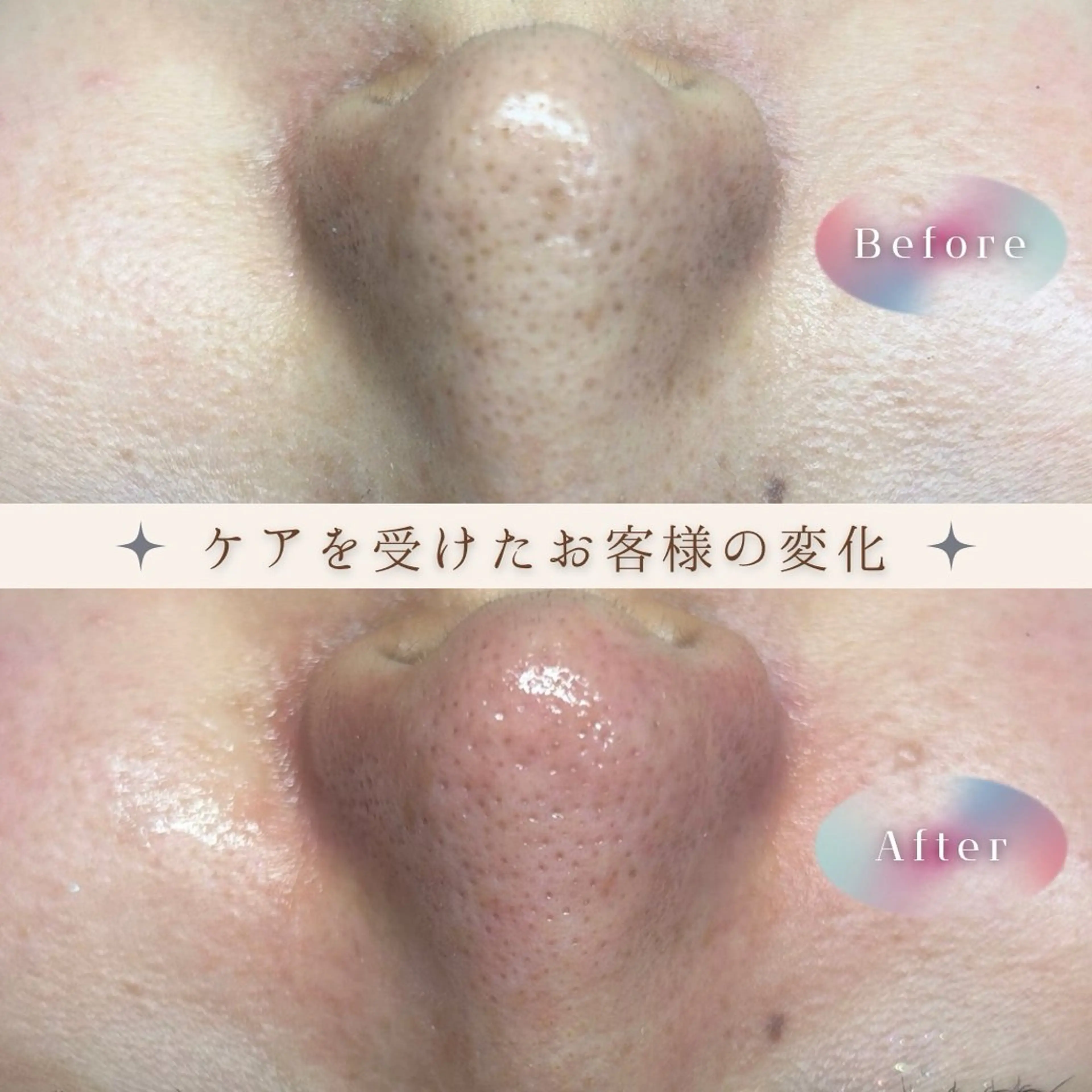 毛穴エクストラクション🍓の写真