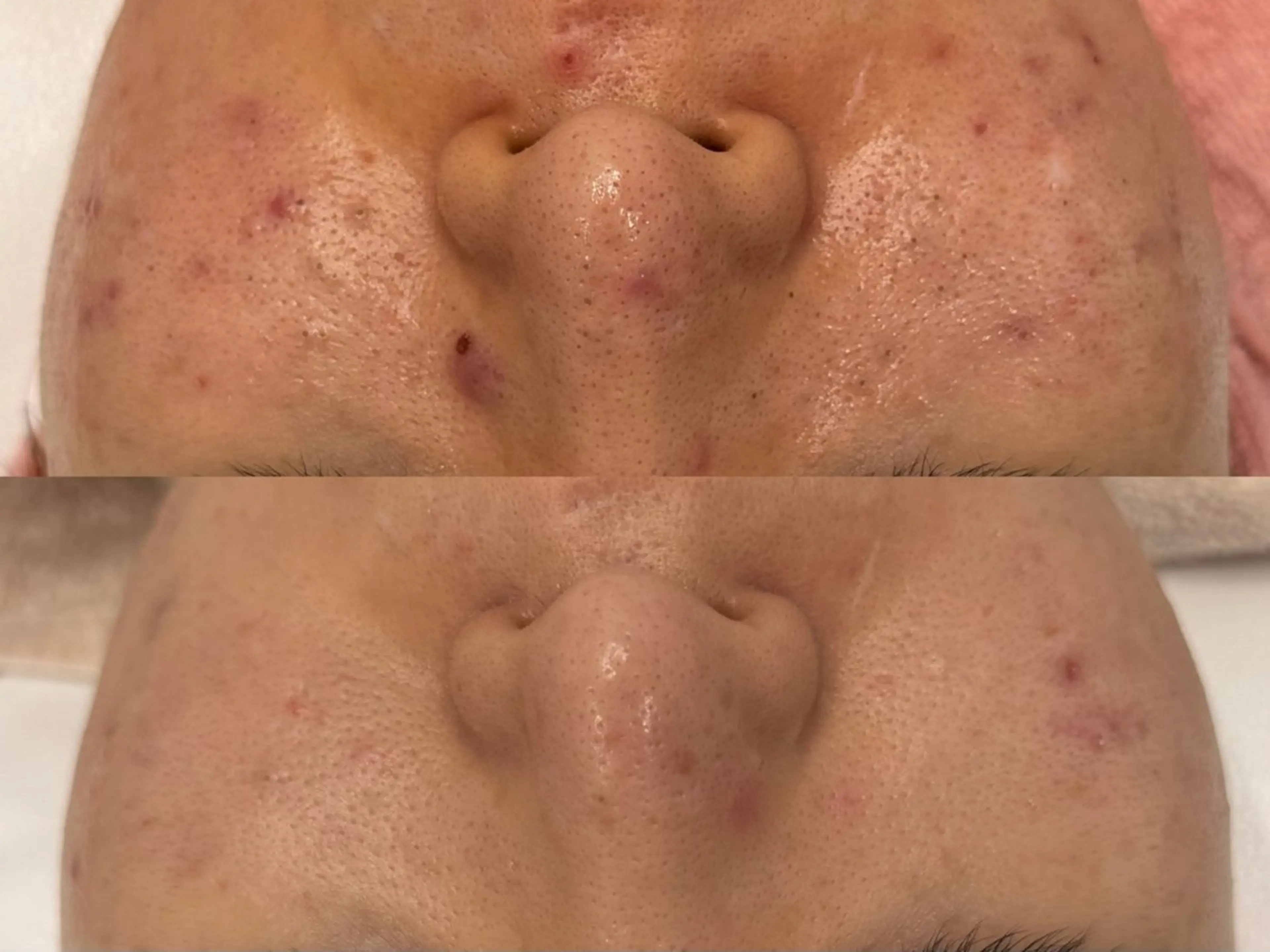 小顔/毛穴/ニキビ salon bealのエステ・リラクイメージ